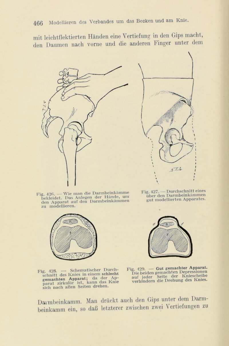mit leichtflektierten Hànden eine Vertiefung in den Gips macht, den Daumen nach vorne und die anderen Finger unter dem Fig. 420. —Wie man die Darmbeinkâmme bekîeidet. Das Anlegen der Ilande, um den Apparat au! den Darnibeinkammen zu modellieren. Fig. 427. — Durchschnitt eines über den Darnibeinkammen gut modellierten Apparates. * Fig 4 28. — Schematischer Durch- schnitt des Knies in einem schlecht gemachten Apparat; (la dei Ap parat zirkular ist, kann das Knie sich nach allen Seiten drehen. Fig. /129. — Gut gemachter Apparat. Die beiden gemachten Depressionen auf ieder Seite der Kniesehcibe verhindern die Drehung des Knies. Davmbeinkamm. Man drückt auch den Gips unter dem Darm- beinkamm ein, so da6 letztercr zwischen zwei Yertiefungen zu