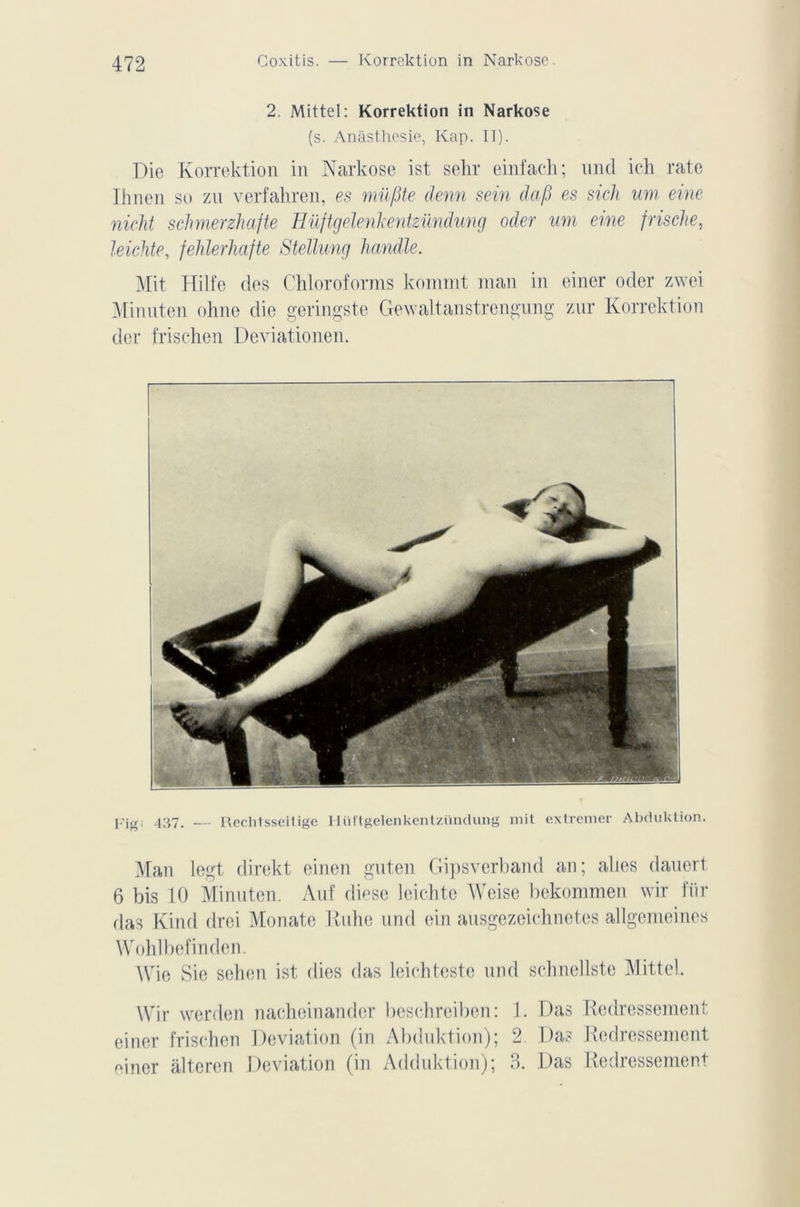 2. Mittel: Korrektion in Narkose (s. Anàsthesie, Kap. II). Die Korrektion in Narkose ist sehr einfach; und ich rate Ihnen so zu verfahren, es müfite demi sein dafi es sich um eine nieht sclmerzhafte Hüftgelenkentzündung oder uni eine frische, leichte, fehlerhafte Stellung handle. Mit Hilfo des Chloroforms kommt man in einer oder zwei Minnten ohne die geringste Gewaltanstrengung zur Korrektion der frischen Deviationen. jrjg; 437. — Rechtsseilige IIürtgelenkentzündung mit extremer Abduktion. Man legt direkt einen gnten Gipsverband an; alies dauert 6 bis 10 Minnten. Auf diese leichte AVeise bekommen wir für das Kind drei Monate Rnhe und ein ausgezeichnetes allgemeines Wohlbefinden. \\rie Sie sehen ist (lies das leichteste und schnellste Mittel. Wir werden nacheinander beschreiben: 1. Das Redressement einer frischen Déviation (in Abduktion); 2 Das Redressement einer alteren Déviation (in Adduktion); 3. Das Redressement