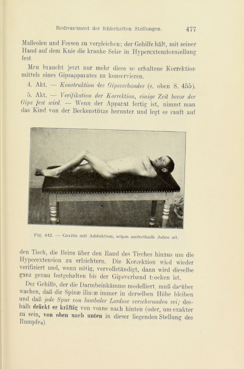 Malleolen une! Feisen zu vergleichen; der Gehilfehalt, mit seiner Hand a ni' dem Knie die kranke Seice in Hyperextensions cellung fest Man biaucht jetzt nnr mehr diese so erhaltene Korrektion mittels eines Gipsappaiates zu konservieren. 4. Akt. — Konstruldion des Gipsverbandes (s. oben S. 455). 5. Akt. T' enfilcation der Korrektion, einige Zeit bevor der Gips fest ivird. — Wenn der Apparat fertig ist, nimmt man das Kind von der Beckenstütze herunter und legt es sanft auf I iff. 442. Goxitis mit Adduktion, scl^on anderthalb Jahre ait. den lisch, die Heine über den Hand des Tisches hinaus uni die Hyperextension zu erloichtern. Die Korrektion wiid wieder vei ifizieit und, wenn nôGg, vervollstandigt, dann wird dieselbe ganz genau festgehaiten bis der Gipsverband trocken ist. Dei Gebilte, der die Darmbeinkâmme modelliert muB da‘liber wachen, daB die Spinæ iliacæ immer in derselben Hohe bleiben und daB je de S pur von lumbaler Lordose verschivunden sei; des- lialb driickt ci* kriiftig von voine nacli hinten (oder, umexakter zu sein, von oben nacli unten in dieser liegenden Steüung des Kumpfes).