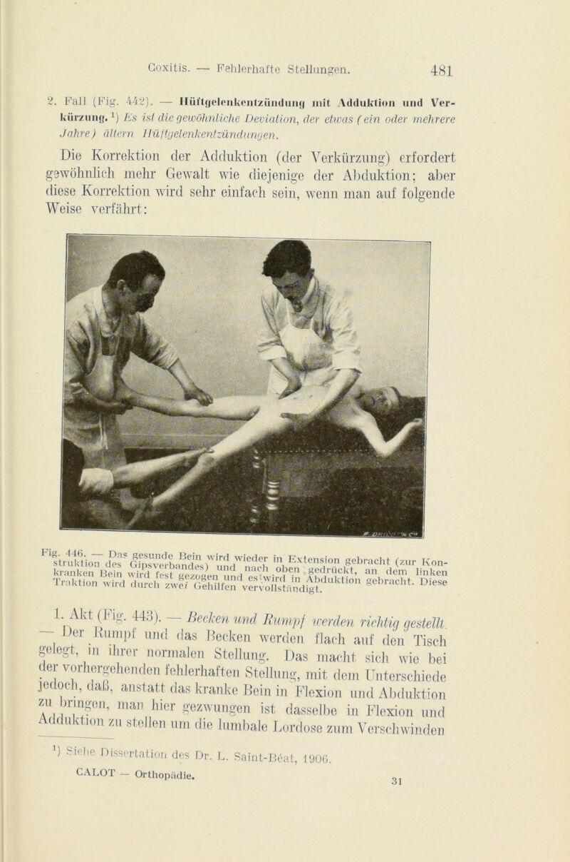 2. Fall (Fig. 442). — llüt'tgeleiikenlzündung mit Adduklion und Ver- kiirzung.L) Es ist die gewôhnliche Déviation, der elwas ( ein oder rnehrere Jalire) âltern Hüftgelenkentzündungen. Die Korrektion der Adduktion (der Verkürzung) erfordert gewohnlich mehr Gewalt wie diejenige der Abduktion; aljer diese Korrektion wird sehr einfach sein, wenn man anf folgende Weise yerfâhrt: 1. Akt (Fig. 443). Leckenund Rumpf werden richtig gestellt. - Der Iviimpf nnd das Becken werden flacli anf den Tisch gelegt, m îhrer normalen Stellung. Das macht sich wie bei der vorhergehenden fehlerhaften Stellung, mit dem Unterschiede jedocn, dan, anstatt das kranke Bein in Flexion nnd Abduktion zu bnngen, man hier gezwungen ist dasselbe in Flexion und ddnktion zu stellen uni die lumbale Lordose zum Verschwinden S Sielie Dissertation des Dr. L. Saint-Béat, 1906. CALOT — Orthopadie.