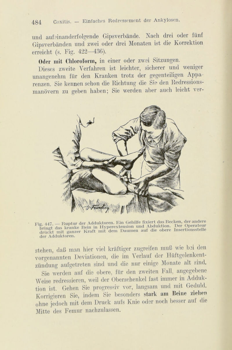 Coxitis. — Einfachcs Redressement der Ankylosen. uncl aufeinanderfolgende Gipsverbânde. Naeh drei oder fünf Gipsverbânden mid zwei oder drei Monaten ist die* Korrektion erreicht (s. Fig. 422—43G). Oder mit Chloroform, in einer oder zwei Sitzungen. Dieses zweite Yerfahren ist leicliter, sicherer nnd weniger unangenehni für den Kranken trotz der gegenteiligen Appa- renzen. Sie kennen schon die Richtung die Sie den Redressions- manôvern zu geben liaben; Sie werden aber auch leicht ver- Fig . 447 Ruptur der Adduktoren. Ein Geliilfe fixiert das Becken, derandere bringt das kranke Bein in Hyperextension und Abduktion. Der Operateur driickt mit ganzer Kraft mit dem Daumen auf die obéré Insertionsstelle der Adduktoren. stehen, daB man hier viel kraftiger zugreifen muB wie bei den vorgenannten Deviationen, die im Verlani der Hüftgelenkent- zündung aufgetreten sind nnd die nur einige Monate ait sind. Sie werden auf die obéré, für den zweiten Fall, angegebene Weise redressieren, weil der Oberschenkel fast immer in Adduk- tion ist. Gehcn Sie progressiv vor, langsam und mit Geduld. Korrigieren Sic, indem Sie besonders stark am Heine zielien ohne jedoch mit dem Druck aufs Knic oder noch besser auf die Mitte des Fémur naehzulassen.