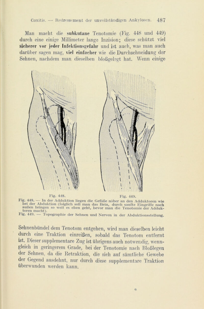 Man macht die subkutane Tenotomie (Fig. 448 und 449) durch eine einige Millimeter lange Inzision; diese scliützt viel sicherer vor jeder Infektionsgefalir und ist aucb, was rnan auch dariiber sagen mag, viel einfaeher wie die Durehschneidung der Sehnen, nachdem man diesel ben bloBgelegt bat, Wenn einige Fig. 448. — Tn der Adduktion liegen die GefiiBe nàber an den Adduktoren wie bei der Abduktion (folglicli soll man das Bein, durch sanfte Eingriffe nach auBen bnngcn so weit es eben geht, bevor man die Tenotomie der Adduk- toren macht). Fig. 449. — Topographie der Sehnen und Nerven in der Abduktionsstellung. Sehnenbündel dent Tenotom entgehen, wird man dieselben leicht durch eine Traktion einreiBen, sobald das Tenotom entfernt ist. Dieser supplementare Zug ist übrigens auch notwendig, wenn- gleich in geringerem Grade, bei der Tenotomie nach BloBlegen der Sehnen, da die Retraktion, die sich auf sâmtliche Gewebe der Gegend ausdehnt, nnr durch diese supplementare Traktion überwunden werden kann.