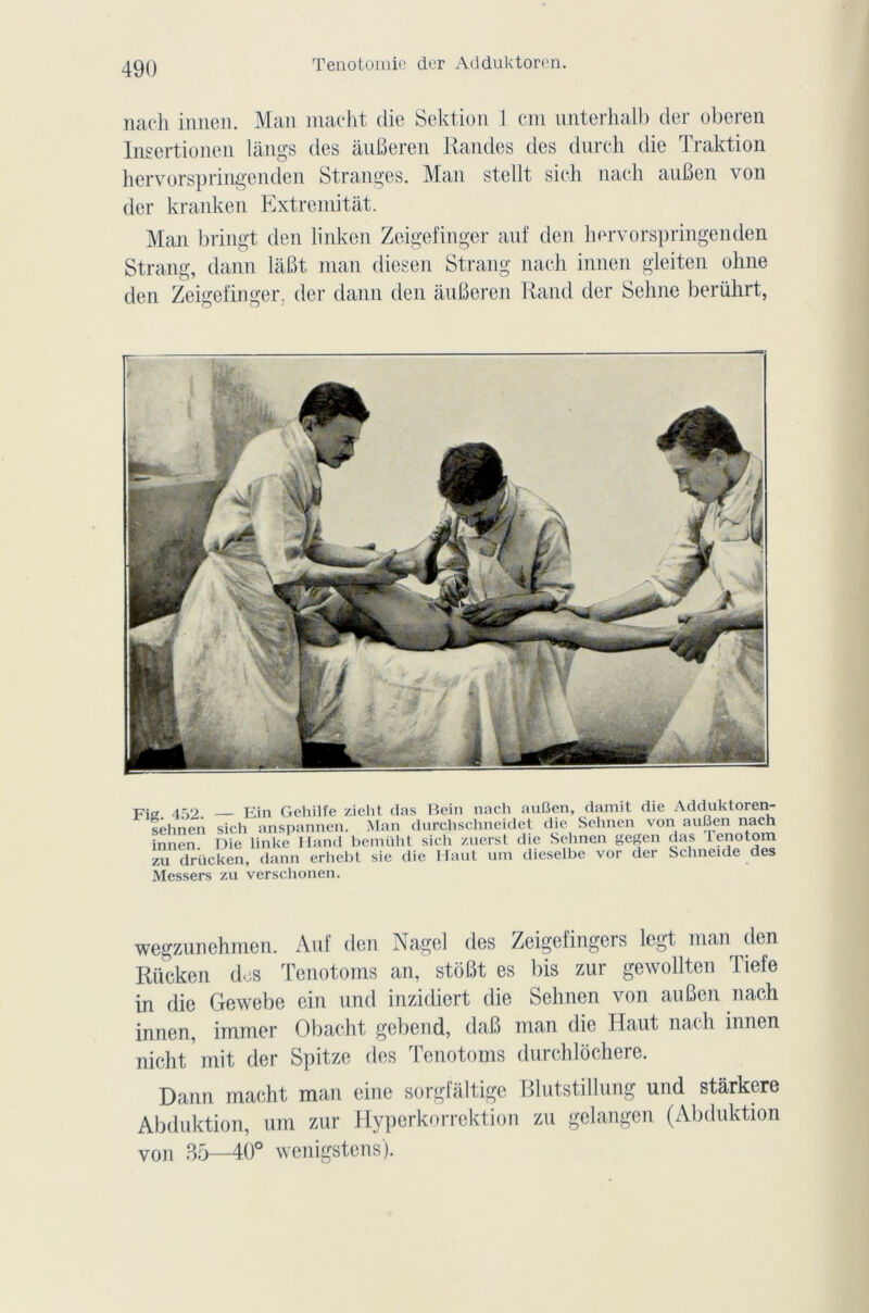 Ténotomie der Adduktoren. nach innen. Man maeht die Sektion 1 cm unterhalb der oberen Insertionen langs des âuBeren Mandes des durch die I raktion hervorspringenden Stranges. Man stellt sich nach auBen von der kranken Extremitàt. Man bringt den linken Zeigefinger anf den hervorspringenden Strang, dann lâBt man diesen Strang nach innen gleiten ohne den Zeigefinger, der dann den âuBeren Rand der Sehne berührt, Fia 452 Ein Gehilfe zieht das Hein nach auBen, damit die Adduktoren- sêhnen sich anspannen. Man durchschneidet die Sehnen von auBen nach innen. Die linke Hand bemüht sich zuerst die Sehnen gegen das lenotom zu drücken, dann erhebt sie die Haut uni dieselbe vor der Schneide des Messers zu verschonen. wegzunehmen. Anf den Nage] des Zeigefingeis legt nran den Riicken clos Tenotoms an, stôBt es bis zur gewollten Tiefe in die Gewebe ein und inzidiert die Sehnen von auBen nach innen, immer Obacht gebend, daB man die Haut nach innen nicht mit der Spitze des Tenotoms durchlôchere. Dann macht man eine sorgfàltige Blutstillung und stârkere Abduktion, um zur Hyperkorrektion zu gelangen (Abduktion von 35—40° wenigstens).