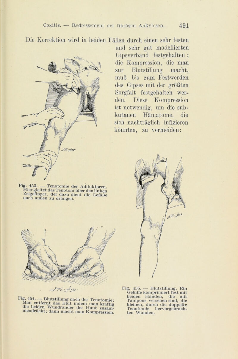 Die Korrektion wird in beiden Fallen durch einen selir festen und selir gut modellierten Gipsverband festgehalten ; die Kompression, die man zur Blutstillung macht, muB b1's zum Festwerden des Gipses mit der groBten Sorgfalt festgehalten wer- den. Diese Kompression ist notwendig, um die sub- kutanen Hamatome. die sich nachtràglich infizieren konnten, zu vermeiden: Fig. 455. — Blutstillung. Ein Gehilfe komprimiert test mit beiden Hânden, die mit Tampons versehen sind, die kleinen, durch die doppelte Tenotomie hervorgebrach- ten Wunden. Fig. 453. -— Tenotomie der Adduktoren. Hier gleitet das Tenotom über den linken Zeigel'inger, der dazu dient die GefàBe nach auBen zu drangen. Flf-454- — Blutstillung nach der Tenotomie: Man entfernt das Blut indem man kraftig die beiden Wundrander der Haut zusam- mendrückt; dann macht man Kompression