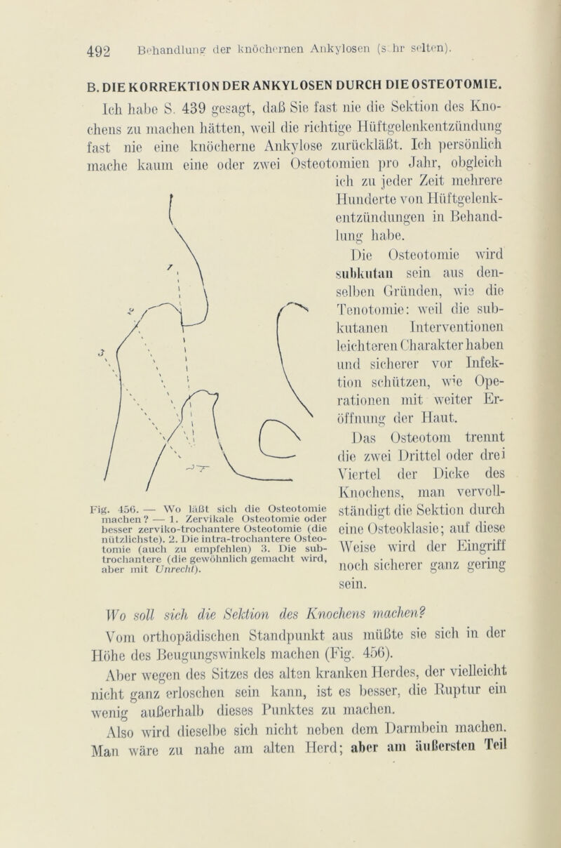 B. DIE KORREKTION DER ANKYLOSEN DURCH DIE OSTEOTOMIE. Ich habe S. 439 gesagt, daB Sie fast nie die Sektion des Kno- chens zu machen hàtten, weil die richtige Hüftgelenkentzündung fast nie eine knocherne Ankylosé zurücklâBt. Ich persônlich mâche kaum eine oder zwei Osteotomien pro Jahr, obgleich ich zn jeder Zeit mehrere I Hunderte von Hiiftgelenk- ( entzündungen in Behand- lung habe. Die Ostéotomie wird subkutan sein aus den- selben Gründen, wie die Tenotomie: weil die sub- kntanen Interventionen leichteren Charakter liaben und sicherer vor Infek- tion schützen, wie Ope- rationen mit weiter Er- ôffnung der Haut. Das Osteotom trennt die zwei Drittel oder drei Yiertel der Dicke des Knochens, man vervoll- stàndigt die Sektion durch eine Osteoklasie; auf diese Weise wird der Eingriff noeh sicherer ganz gering sein. Fig. 456. — Wo liiBt sicli die Ostéotomie machen? — 1. Zervikale Ostéotomie oder besser zerviko-trochantere Ostéotomie (die nützlichste). 2. Die intra-trochantere Ostéo- tomie (auch zu empfehlen) 3. Die sub- trochantere (die gewohnlich gemacht wird, aber mit Unrecht). Wo soll sich die Sektion des Knochens machen? Vont orthopâdischen Standpunkt aus müBte sie sich in der Hohe des Beugungswinkels machen (Fig. 456). Aber wegen des Sitzes des alten kranken Hcrdes, der vielleicht nicht ganz erloschen sein kann, ist es besser, die Ruptur ein wenig auBerhalb dieses Punktes zu machen. Also wird dieselbe sich nicht neben dem Darmbein machen. Man ware zu nahe am alten Herd; aber am âuBcrsten Teil