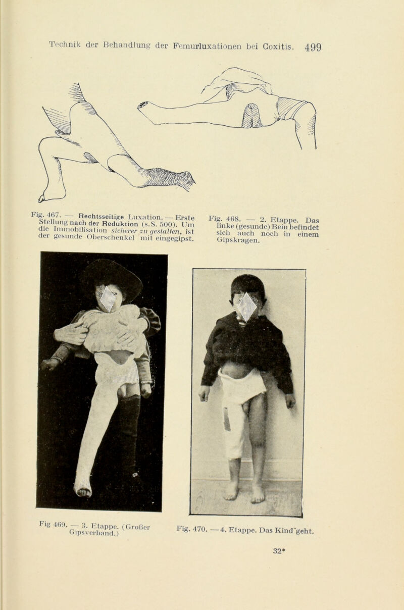 Fl£\4£'- Rechtsseitige Luxation. — Erste btellung nach der Reduktion (s.S. 500). Uni tue Immobilisation sicherer zu gestcülen, ist der gesunde Oberschenkel mit eingegipst. Fig. 468. — 2. Etappe. Das linke (gesunde) Bein befindet sich auch noch in einem Gipskragen. F‘g 469- ~ 3- Etappe. (GroRer Gipsverband.) Fig. 470. —4. Etappe. Das Kind'geht. 32*