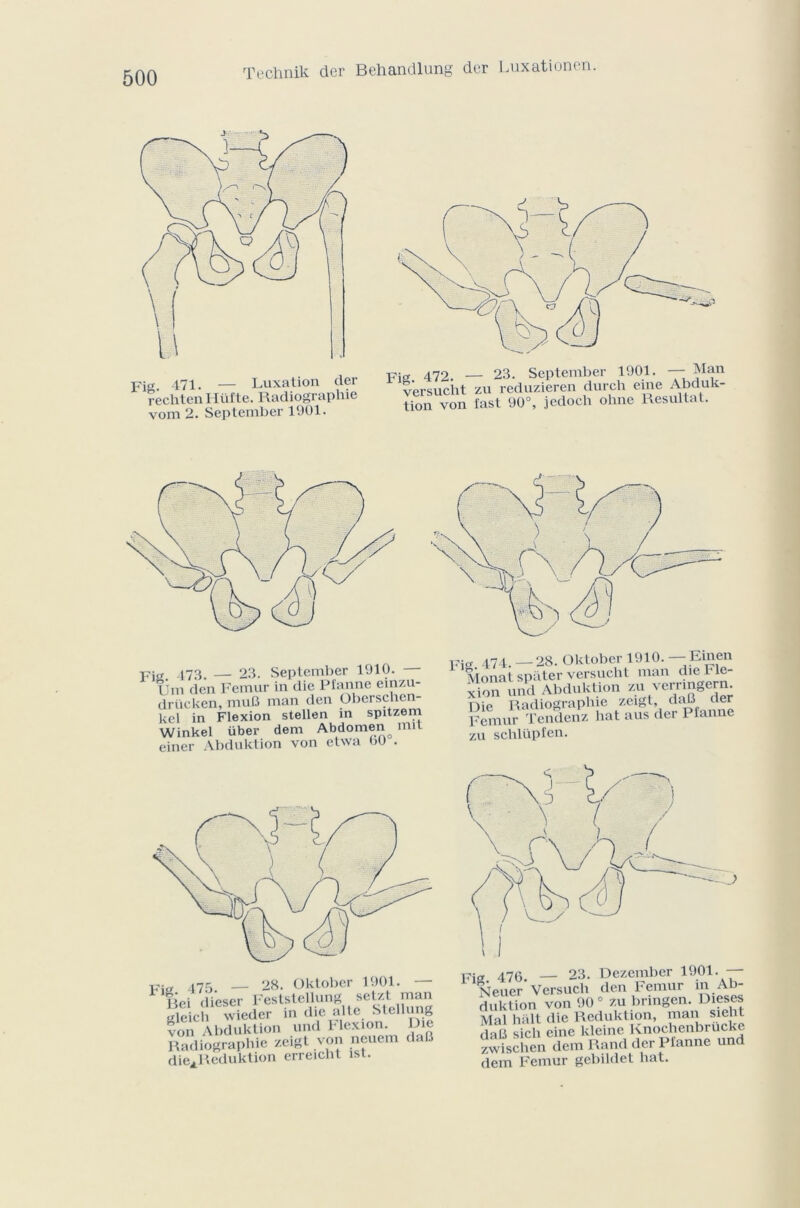 Technik der Behandlung der Luxationen. Fi 471. — Luxation der rechtenHüfte. Radiographie vom 2. September 1901. 472. — 23. September 1901. — Man versucht zu reduzieren durch eme Abduk- tion von fast 90°, jcdoch ohne Résultat. Fi„ i73. — 23. September 1910. — Um den Fémur in die Pfanne einzu- driicken, muS man den Oberschen- kel in Flexion stellen m spitzem Winkel über dem Abdomen mil einer Abduktion von etwa 00 . Fig 474.-28. Oktober 1910.- Emen Monatspater versucht man d.e Fle- xion und Abduktion zu verringern Tl io Radiographie zeigt, daB der Fémur Tendenz hat aus der Pfanne zu schlüpfen. -Pia ahc. — 28. Oktober 1901. — Hoi dieser Feststellung setzt man •deich wieder in die al te Stellung von Abduktion und Flexion. Die Radiographie zeigt von neuem daB die.Reduktion crreiclit ist. 47Q. 23. Dezember 1901. Relier* Versuch den Fémur in Ab- luktion von 90° zu bringen. Dieses 4al hait die Reduktion, man sieht jaB sich eine kleine Knochenbrucke 'wischen dem Rand der Pfanne und