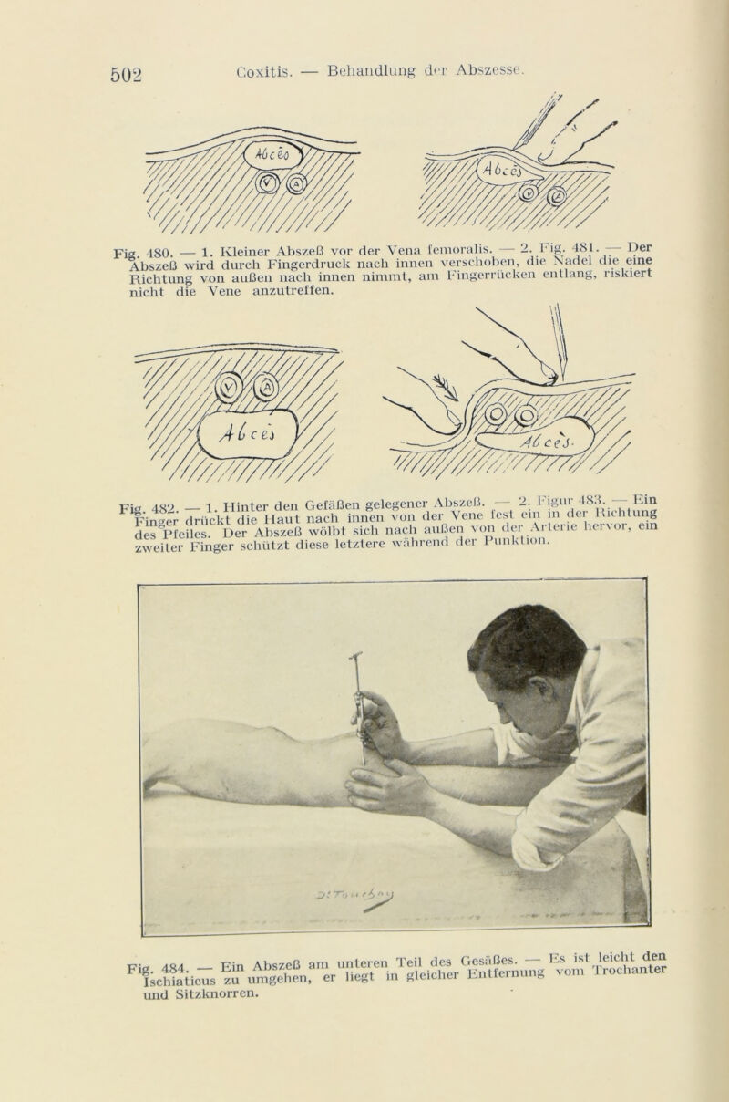 Fig. 480. — 1. Kleiner AbszeB vor der Vena femoralis. — 2. l ig. 481. — Der AbszeB wird durch Fingerdruck nach innen verschoben, die Nadel die eine Richtung von auBen nach innen nimmt, am Fingerriicken entlang, riskiert nicht die Vene anzutreffen. Fig 482. — 1. H in ter den GefâBen gelegener AbszeB. — 2. Figui j 48:J*. . Fin-er drückt die Haut nach innen von der Vene test em n du Richtung desTPfeiles. Der AbszeB wolbt sich nach auBen von der Artene her\or, ein zweiter Finger schützt diese letztere wahrend der 1 unktion. und Sitzknorren.