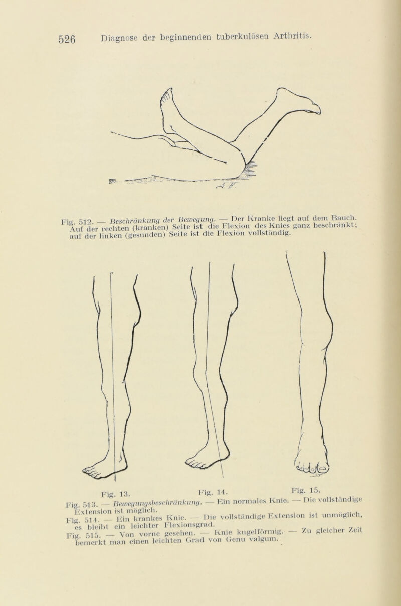 pio- 519 Beschrànkung der Bewegung. — Der Kranke liegt auf dein Bauch. \uf der rechten (kranken) Seile isl die Flexion des Knies ganz beschrankt; auf de,- linken (gesunden) Seite isl die Flexion vollstandig. Fig. 14. Fig. 15. Extension ist mogucn. Fig. 514. — Ein krankes Knie. es hleibt ein leichlcr Flexionsgrad. T'iü 515. — Von vorne geselien. — Knie kugelfôrmig bemerkt man einen leicliten Grad von Genu valgum. Die vollstiindige Extension isl unmôglich, Zu gleicher Zeit
