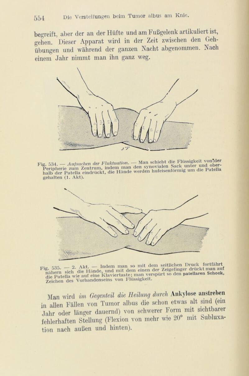Die Versteifungen beim Tuitiof albus am Ivnie. begreift, aber der an der Hüfte und am Fufigelenk artikuiiert ist, gehen. Diesel* Apparat wird in der Zeit zwischen den Geh- übungen und wàhrend der ganzen Nacht abgenommen. Nach einem Jalir nimmt man ihn ganz weg. Fig. 534. — Aufsuchen der Fluktuation. — Man schiebt.die* Perioherie zum Zentrum, indem man den synovialen Sack unie! una oüer halbder Patella eindrückt, die Hânde werden hufeisenformig uni die 1 at gehalten (1. Akt). V Man wird tm Gegenteil die Heilung durcli Ankylosé anstrcben in allen Fallen von Tumor albus die schon etwas ait sind (ein dahr oder langer dauernd) von schwerer Forin mit sichtbarer fehlerhaften Stellung (Flexion von mehr wie 20° mit Subluxa- tion nach au ben und hinten).