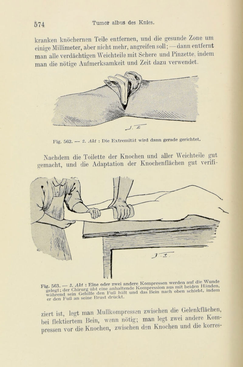 kranken knôchernen Teile entfernen, und die gesunde Zone uni einige Millimeter, aber ni élit mehr, angreifen soll ; — dann entfernt man aile verdâchtigen Weichteile mit Sehere und Pinzette. indeni man die nôtige Aufmerksamkeit und Zeit dazu verwendet. Fig. 562. 2. Aid : Die Extremitat wird dann gerade gerichtet. Aachdem die Toilette der Knochen und aller Weichteile gut gemacht, und die Adaptation der Knochenflachen gnt \eiifi- ■ co 7 M i - Fine oder 7,\vei andere Kompressen werden auf die Wunde er den Fuü an seine Brust drückt. ziert ist, legt man Mullkompressen zwischen die Gelenkflâchen, bei flektiertem Bein, wenn nôtig; man legt zwei andere Kom- pressen vor die Knochen, zwischen den Knochen und die korres-