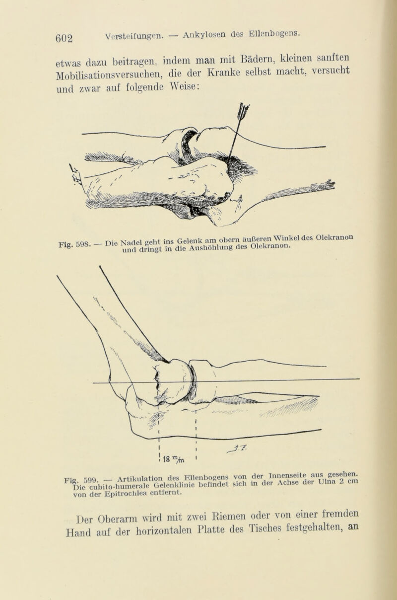Versteifungen. — Ankylosen des Ellenbogens. etwas dazu beitragen. indem man mit Bâdern, kleinen sanften Mobilisationsversuchen, die der Kranke selbst macht, versucht und zwar auf folgende Weise : Vif, _ Die Nadel geht ins Gelenk am obern auBeren Winkel des Olekranon Fig. 598. - D.e Nadège ^ ^ ^ Aushôhlung des Olekranon. Fig 599 — Artikulation des Ellenbogens von der Innraswte *uTSnf*S |h®m Die cubito-humerale Gelenklinie beündet sich m der Achse der Ulna 2 cm von der Epitrochlea entfernt. Der Oberarm wird mit zwei liiemen oder von einer fremden Hand auf der horizontalen Flatte des Tisches festgehalten, an