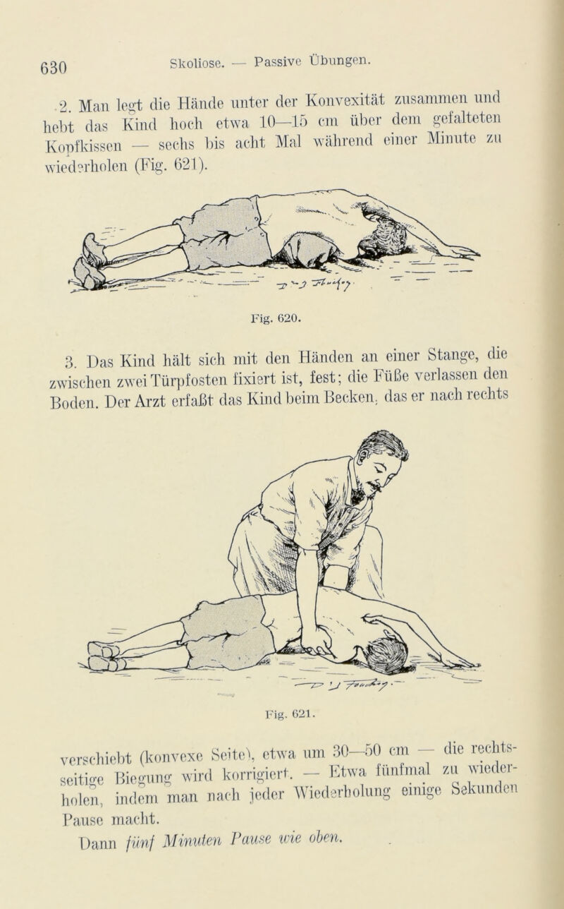 2. Man legt die Hânde miter der Konvexitât zusammen und hebt das Kind hoch etwa 10—15 cm über dem gefalteten Kopfkissen — sechs bis acht Mal wàhrend einer Minute zu wiederholen (Fig. 621). Fig. G20. 3. Das Kind hait sicli mit den Hànden an einer Stange, die zwisohen zweiTürpfosten fixiert ist, fest; die FüBe verlassen den Boden. Der Arzt erfafit das Kind beim Becken, das er nacli reehts verschiebt (konvexc Seitei, etwa um 30—50 cm die rechts- seitige Biegung wird korrigicrt. - Etwa fünfmal zu wieder- holen, indem man naeh jedcr Wiederbolung «rage Sekunden Pause macht. Dann füïif Mifiuteu Pause v ie oben.