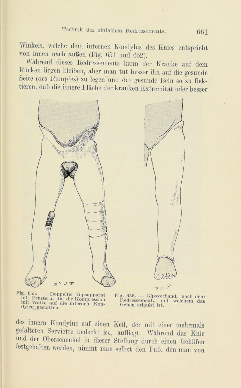 Technik des einfachen Redressements. inkels, welche dem internen Kondvlus des Knies entspricht von innen nach au Ben (Fig. 651 und 652). Wàhrend dieses Redressements kann der Kranke auf dem Riicken liegen bleiben, aber man tut besser ihn auf die gesunde Seite (des Rumpfes) zu legen und das gesunde Rein so zu flek- tieien, daB die innere b lâche der kranken Extremitât oder besser des innern Kondylus auf einen Keil, der mit einer mehrmals gefalteten Serviette bedeckt ist, aufliegt. Wâbrend das Knie und der Oberschenkel in dieser Stellung durch einen Gehilfen iestgehalten werden, nirnmt man selbst den FuB, den man von