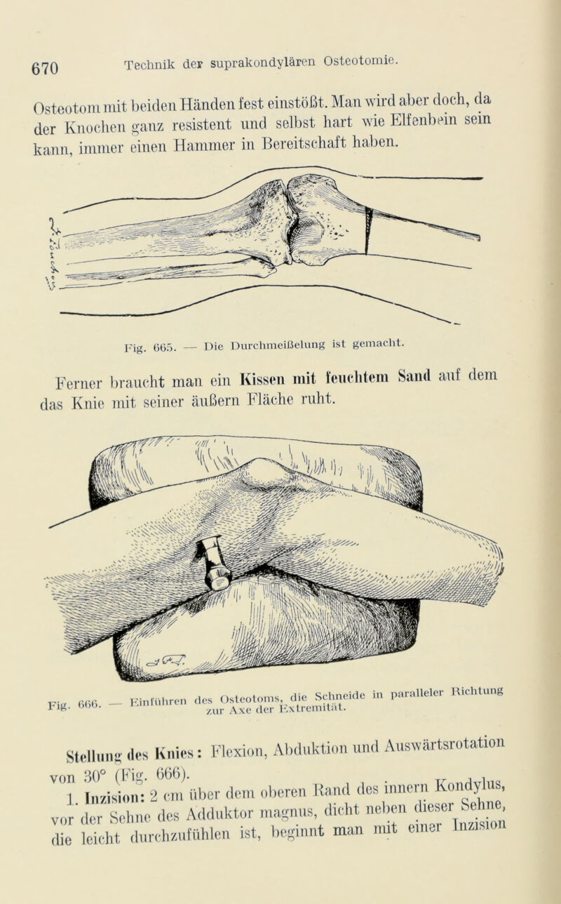Technik der suprakondylâren Ostéotomie. Osteotom mit beiden Hânden fest einstoBt. Man wird aber doch, da der Knochen ganz résistent und selbst hart wie Elfenbein sein kann, immer einen Hammer in Bereitschaft haben. Ferner braucht man ein Kissen mit feuchtem Saml anf dem das Knie mit seiner ânBern Mâche ruht. Fig. 666. Eini'ühren des Osteotoms, die Schneide in paralleler Richtung zur Axe der Extremitàt. Stellu.is des Knics: Flexion, Abduktion und Auswârtsrotation von 30° (Fig. 666). ,. i i 1 Inzision: 2 cm über dem oberen Rand des mnern Rondylus, vor der Sehne des Adduktor magnus, dicht neben dieser Sehne, die leicht durchzufühlen ist, beginnt man mit einer Inasio.