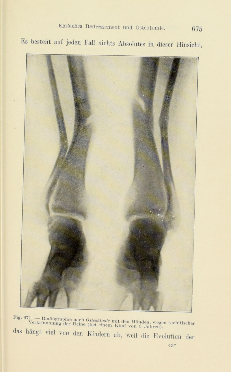 Einfâches Redressement und Ostéotomie. Es besteht auf jeden Fall nicltts Absolûtes in dieser Hinsicht, h ig. 671. —- Radiographie nach Osleokla. Verkrummung der Beine (bei ein das liangt vie! von den Kinde: mit den ILinden, wegen rachitischer Ivmd von G .Jaliren). ab, weil die Evolution der 43*