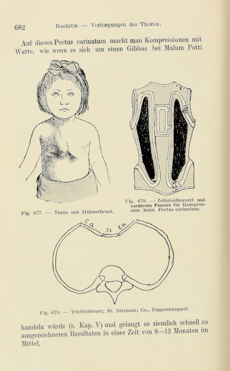 Aui cliesen Peetus carinatum macht man Kompressionen mit Watte. wie wenn es sieli um einen Gibbus bei Malum I otti Fig. 677 — Torax mit Hiihnerbrust. Fig. 678. — Zelluloidkorsett mit vorderem Fenster iur Komi)res- sion beim Peclus carinatum. handeln würde (s. Kap. V) und gelangt so ziemlich sehneü zu ausgczeichncten Resultaten in einer Zeit von 8-12 Monaten nn Mittel.