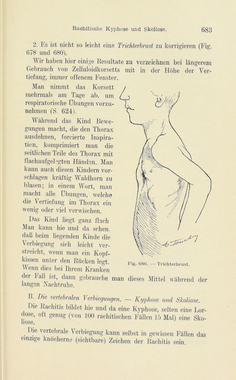 2. Es ist nicht so leicht eine Trichterbrust zu korrigieren (Fig. 678 und 680). Wir haben hier einige Resultate zu verzeichnen bei lângerem Gebrauch von Zelluloidkorsetts mit in der Hohe der Ver- tiefung, immer offenem Fenster. Man nimmt das Korsett mehrmals am Tage ab. uni respiratorische Übungen vorzu- nehmen (S. 624). Wâhrend das Kind Bewe- gungen macht, die den Thorax ausdehnen, forcierte Inspira- tion, komprimiert man die seitlichen Teile des Thorax mit flachaufgelegten Hàndsn. Man kann auch diesen Kindern vor- schlagen krâftig Waldhorn zu blasen; in einem Wort, man macht aile Übungen, welche die Vertiefung im Thorax ein wenig oder viel verwischen. Das Kind liegt ganz flach Man kann hie und da sehen. daB beim liegenden Kinde die Verbiegung sich leicht ver- streicht, wenn man ein Kopf- kissen unter den Rücken legt. M enu dies bei Ilirem Kranken der hall ist, dann gebrauche n langen Nachtruhe. dieses Mittel wâhrend der B. Die vertebralen Verbiegungen. — Kyphose und Skoliose. Die Baehitis bildet hie und da eine Kyphose, selten cine Lor- dose, oit genug (von 100 rachitisclien Fâllen 15 Mal) eine Sko- Die vertébrale Verbiegung kann selbst in gewissen Fâllen das emzige knocherne (sichtbare) Zeichen der Rachitis sein.