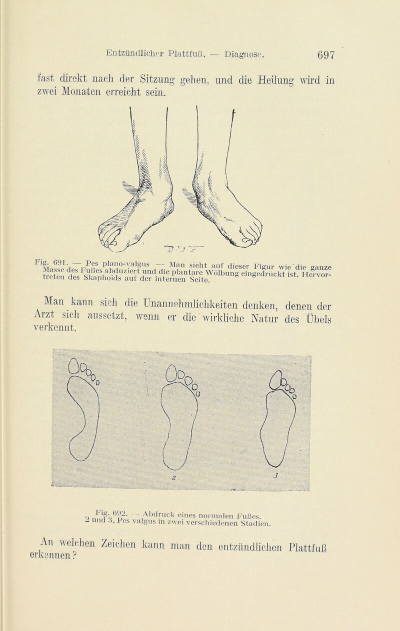 fast direkt naeli der Sitzung gehen, und die Heilung wird in zwei Monaten erreicht sein. r inf r/ 5 plano-valgus — Man sieht auf dieser Figur wie'die ganze Masse des FuLies abduziert und die plantare Wôlbun® eingedrückt isl TTervnr treten des Skaphoids auf der internen Seite. 8 emgearuckt ist. Hervor- Man kann sich die Unannehmlichkeiten denken, denen der Arzt sich anssetzt, wenn er die wirkliche Natnr des Übels verkennt. ) Abdruck eines normalen Fu(3es. - unu .i, i es valgus in zwei verschiedenen Stadien. An welchen Zeichen kann man den entzündlichen Plattfufi erkennen ?