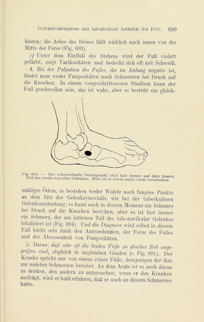 hinten; die Achse des Beines fâllt wirklich nach innen von der Mitte der Ferse (Fig. 693). c) [ nter dem EinfluB des Stehens wird der FuB violett gefârbt, zeigt Varikositâten und bedeckt sich oft mit SchweiB. 4. Bei der Palpation des Fu/jes, die im Anfang negativ ist, findet man weder Fungositàten noch Schmerzen bei Druck auf die Knochen. In einem vorgeschritteneren Stadium kann der FnB geschwollen sein, das ist wahr, aber es besteht ein gleicli- màBiges Ôdem, es bestehen weder Wnlste noch fungose Pnnkte an dem Sitz der Gelenksynovialis, wie bei der tuberkulosen Gelenkentzündung ; es kann auch in diesem Moment ein Schmerz bei Druck auf die Knochen bestehen, aber es ist fast immer ein Schmerz, der am internen Teil des talo-naviknlar Gelenkes lokalisiert ist (Fig. 694). Und die Diagnose wird selbst in diesem hall leicht sein dank den Antezedenzien, der Form des FuBes und der Abwesenheit von Fungositàten. 5. Dur an, dafi sehr oft die beiden Fiifie zu gleicher Zeit ange- griffen sind, obgleich in ungleichen Graden (s. Fig. 691). Der Kranke spricht nur von einem seiner FiiBe, demjenigen der ihm am meisten Schmerzen bereitet. An dem Arzte ist es auch daran zu denken, den andern zu untersuchen; wenn er den Kranken ausfiâgt, wird er bald erfahren, daB er auch an diesem Schmerzen hatte.