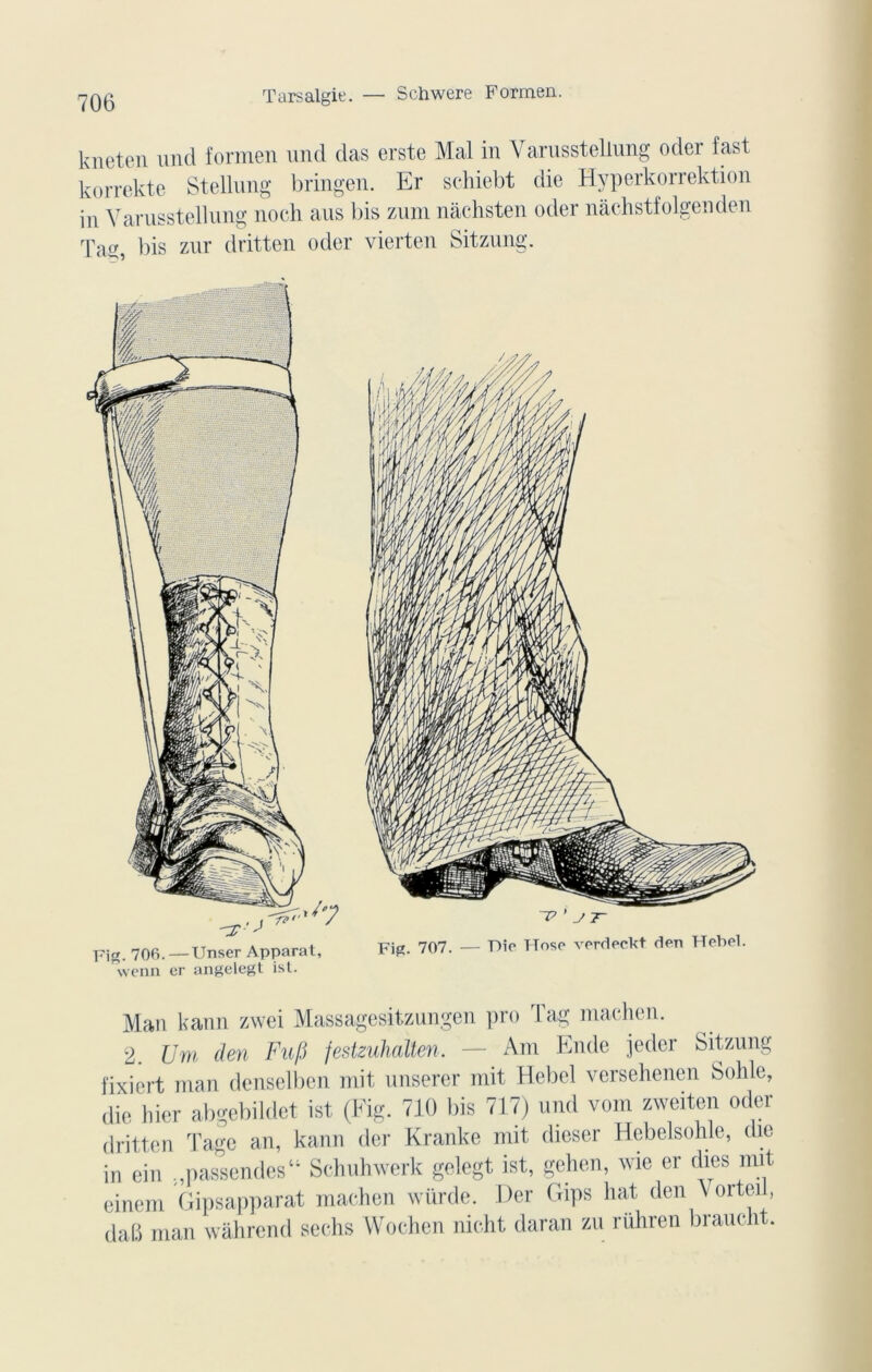Tarsalgie. — Schwere Formen. kneten und formen und das erste Mal in Yarusstellung oder fast korrekte Stellung bringen. Er schiebt die Hyperkorrektion in Yarusstellung noch aus bis zum nàchsten oder nâchstfolgenden Tag, bis zur dritten oder vierten Sitzung. Man kann zwei Massagesitzungen pro Tag machen. 2. Uni den Fufi festzuhalten. — Am Finie jeder Sitzung fixiert man denselben mit unserer mit Hebel versehenen Solde, die hier abgebildet ist (Fig. 710 bis 717) und vom zwciten oder dritten Tage an, kann dcr Kranke mit dieser Hebelsohle, die in ein ;,passendes“ Schuhwerk gelegt ist, gehen, wie er dies mit einerii Gipsapparat machen würde. Der Crips liât den V orteil, dab man wàhrend sechs Wochen nicht daran zu rühren braucht.