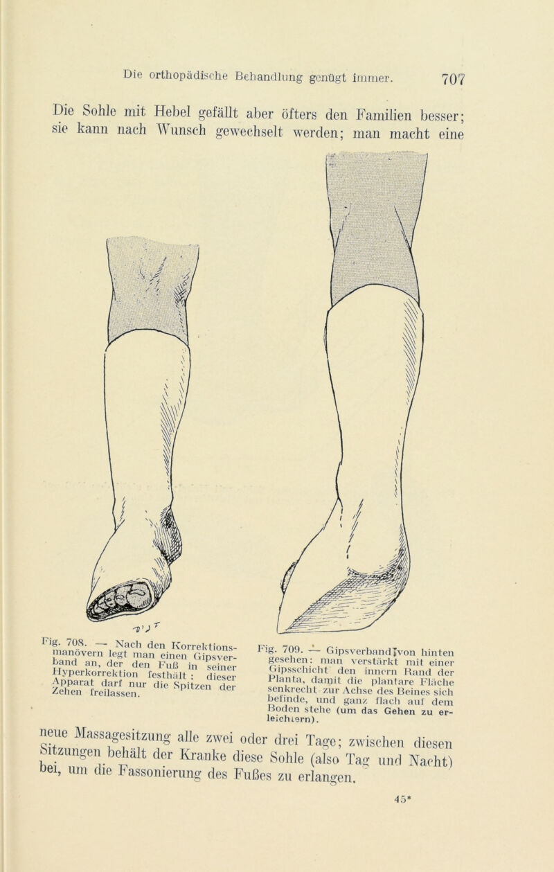 Die Solile mit Hebel gefâllt aber ofters den Familien besser; sie kann nach W unsch gewechselt werden ; man macht eine r ‘g 708. — Nach den Korrektior manovern legt man einen Gipsvi S fn’ der den Fut! in sein Hyperkorrektion festliait • dies Apparat darf nur die Spitzen d /ehen ireilassen. hig. /09. Gipsverbandjvon hinten gesehen: man verstàrkt mit einer Gipsscliieht den innern Rand der Planta, damit die plant are Flache senkrecht zur Achse des Reines sicli belinde, und ganz flach aul dem Roden stehe (um das Gehen zu er- leicluern). neue Massagesitzung aUe zwei oder drei Tage; zwischen diesen Sitzungen behâlt der Kranke diese Solde (also Tag und Naeht) »ei, um die Fassomerung des FuBes zu erlangen. 45*