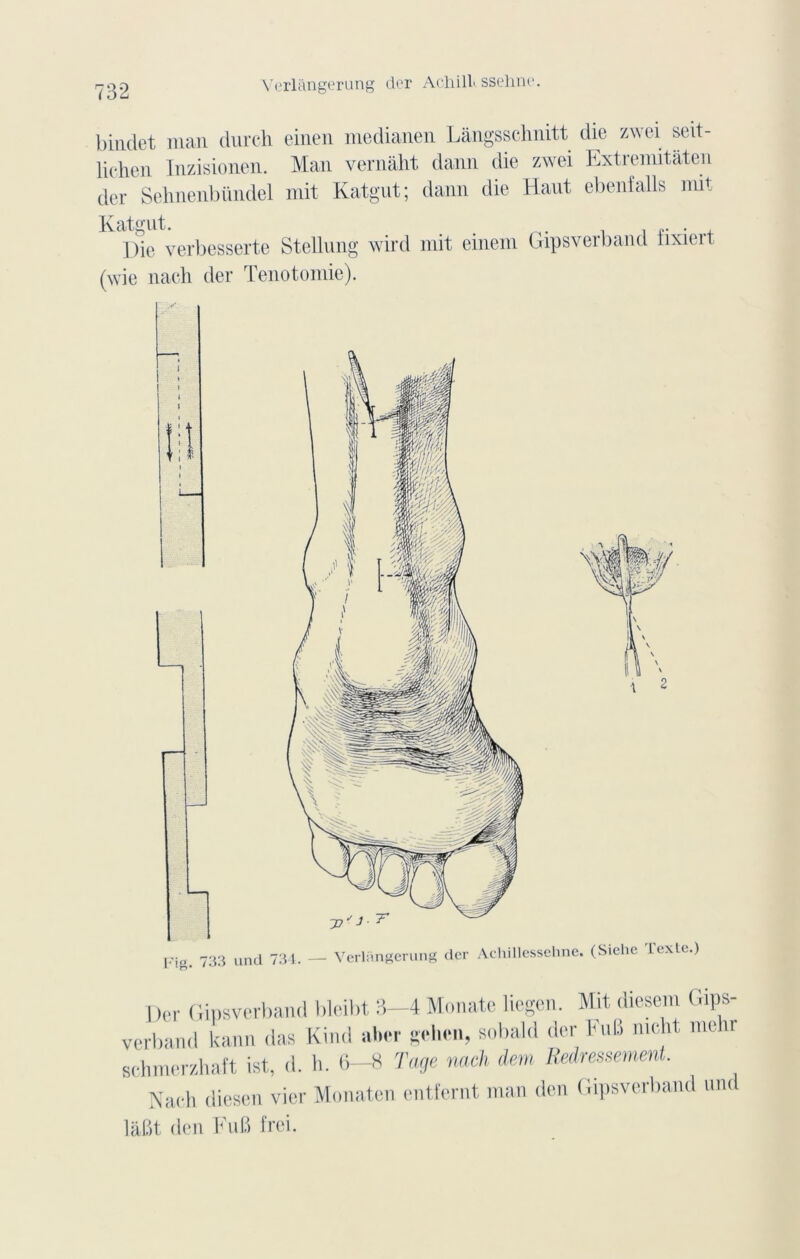 Verlàngerung der Achillt sselm*’. bindet man durch einen medianen Langsschnitt die zwei seit- lichen Inzisionen. Man vernâht daim die zwei Extremitâten der Sehnenbündel mit Katgut; daim die Haut ebenfalls mit Katgut. Die verbesserte Stellung wird mit einem (wie nach der Tenotomie). Gipsverband fixiert Der Gipsverband bleibt 3—4 Monate liegcn. Mit diesem Gips- verband kann das Kind aber gclicn, sobald der KuB nidit me u schmerzhaft ist, d. h. 6-8 Tage nach dem Redressement. Nach diesen vier Monaten entfernt man den Gipsverband und làBt den Eu B frei.