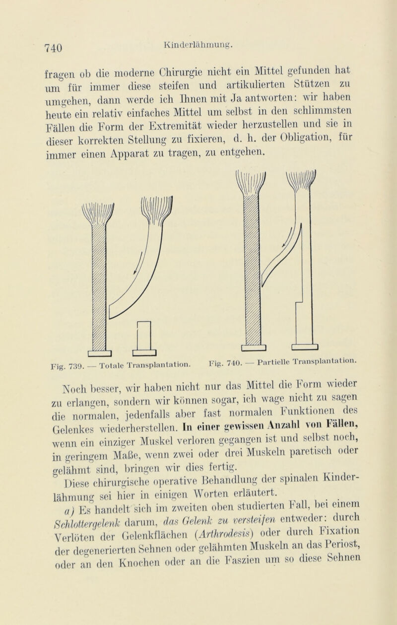 fragen ob die moderne Chirurgie nicht ein Mittel gefunden hat \u\\ für immer diese steifen und artikulierten Stützen zu umgehen, dann werde ich Ihnen mit Jaantworten: wir haben heute ein relativ einfaches Mittel uni selbst in den schlimmsten Fallen die Form der Extremitàt wieder herzustellen und sie in dieser korrekten Stellnng zu fixieren, d. h. der Obligation, für immer einen Apparat zu tragen, zu entgehen. Fig. 740. — Partielle Transplantation. Noch besser, wir haben nicht nur das Mittel die Form wieder zu erlangen, sondern wir konnen sogar, ich wage nicht zu sa^en die normalen, jedenfalls aber fast normalen Funktionen des Gelenkes wiederherstellen. In einer gewissen Anzahl von Fallen, wenn ein einziger Muskel verloren gegangen ist und selbst noch, in geringem Malte, wenn zwei oder drci Muskeln paretisch oder gclàhmt sind, bringen wir dies fertig. Diese chirurgische operative Behandlung der spmalen hindei- làhmung sei hier in einigen Wortcn erlâutert. a) Es handelt sich im zweiten oben studierten hall, bei einem SchlottergeUnk darum, das Gelenk zu vmteifen entweder: dun-h Verliiten der Gelenkflâchen (Arthrodesis) oder durch lnxation der degeneriertenSehncn oder gelâhmtenMuskeln an dasPeriost, oder an den Knochen oder an die Faszien »m so diese Schnen