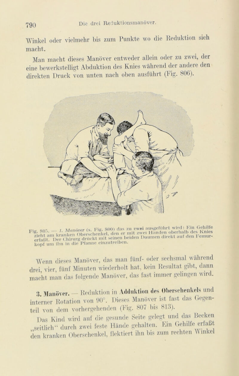 Die drei Reduktionsmanôver. Winkel oder vielmehr bis zum Punkte wo die Reduktion sich macht. Man macht dieses Manover entweder allein oder zu zwei, der eine bewerkstelligt Abduktion des Knies wâhrend der andere den direkten Druck von nnten nach oben ausführt (Fig. 806). Qn- / Manover (s. Fig. 800) (las zu zwei ausgeführt wird: Fin Gehilfe \ , ‘ | M ohei schenkel don er mit zwei H an den oberhalb des Knies IrfaBt1 De?-*Chirurgdriickt mit seine» beiden Daumen direkt auf den Fémur, kopï uni ihn in die Pl'anne einzutreiben. AVenn dieses Manover, das man fünf- oder sechsmal wâhiend drei vier fünf Minuten wiederholt liât, kein Résultat gibt, dann macht man das folgende Manover, das fast immer gelingen wird. 3 Manover. — Reduktion in Adduktion des Obersehenkels und interner Rotation von 90°. Dieses Manover ist fast das Gegen- tcil von dem vorhergehenden (Fig. 807 bis 81.-5). Das Kind wird auf die gesunde Seite gelegt und das Becken seitlich “ dnrch zwei teste Hânde gehalten. Fin Gehilfe erfabt den kranken Oberschenkel, flektiert ihn bis zum rechten A\mkel