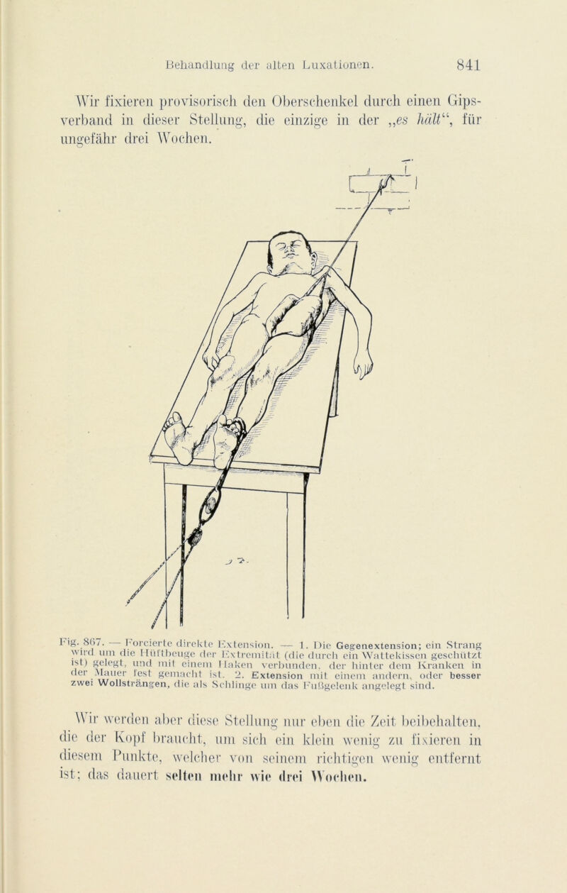 Wir fixieren provisorisch den Oberschenkel durch einen Gips- verband in dieser Stellung, die einzige in der „es haltu, für ungefâhr drei Wochen. Fig. 8(>/. l'orcierte direkto Kxtension. — 1. I)ie Gegenextension; cin Strang \n ircl uni die HiUtbcuge der Kxtremitat (die durch ein Wattekissen geschützt ist) gelegt, und mit cinein Ilaken verbunden. der hinlcr dem Kranken in der Mauer lest gemaeht ist. 2. Extension mit einem andern., oder besser zwei Wollstràngen, die als Schlinge uni das l'uBgeienk ange'egt sind. \\ ir werden aber dièse Stellung nur eben die Zeit, beibehalten, die der Kopf brandit, uni sich ein klein wenig zu fixieren in diesem Punkte, welcher von seinem richtigen wenig entfernt ist; das dauert selten midir vvie drei \Voehen.