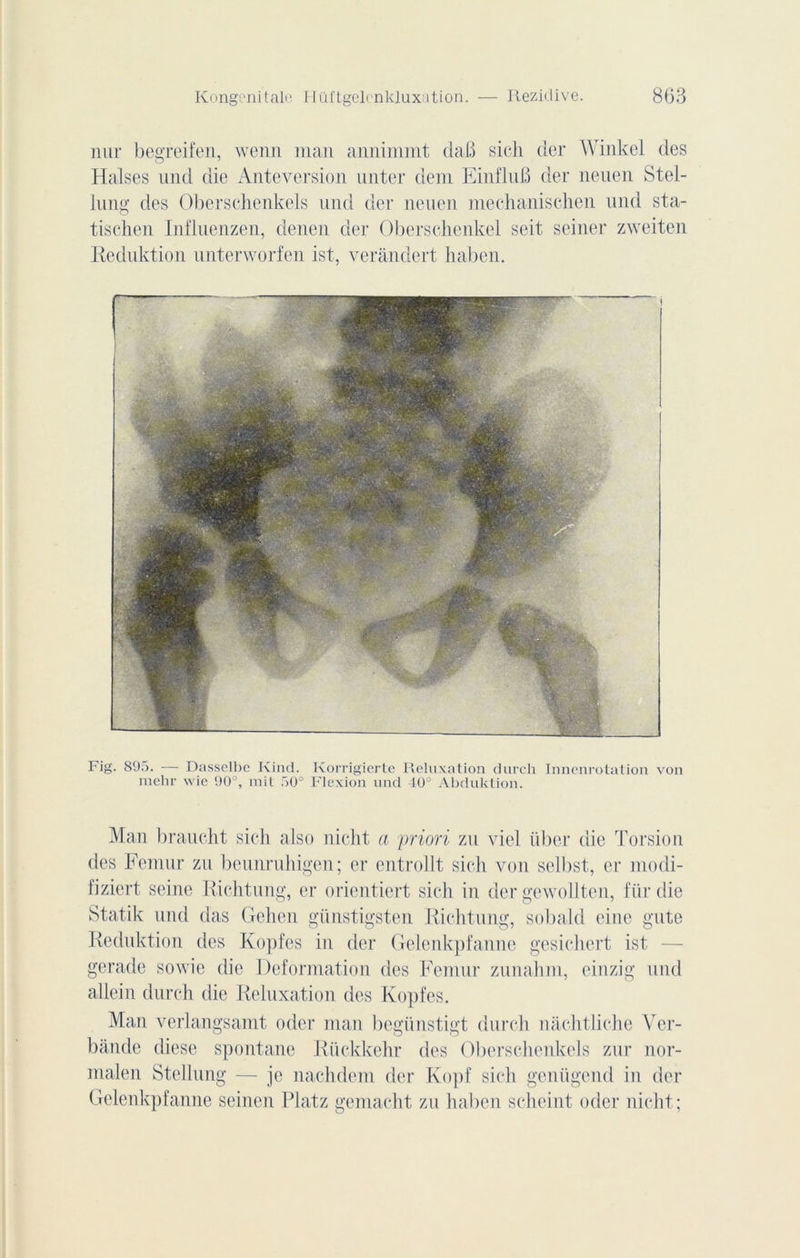 nur begreifen, wenn man annimmt daB sich der Winkel des Halses und die Antéversion unter dem EinfluB der neuen Stel- lung des Oberschenkels und der neuen mechanischen und sta- tischen Influenzen, denen der Oberschenkel seit seiner zweiten Eeduktion unterworfen ist, veràndert haben. Fig. 895. — Dasselbe Kind. Korrigierte Reluxation durch Inncnrotation von niehr wie 90°, mit 50° Flexion und 40° Abduktion. Man brauclit sich also nicht a priori zu viel liber die Torsion des Fémur zu beunruhigen; er entrollt sich von selbst, er modi- fiziert seine Riehtung, er orientiert sich in der gewolltcn, für die Statik und das Gehen günstigsten Riehtung, sobald eine gute Reduktion des Kopfes in der Gelenkpfanne gesichert ist gerade sowie die Deformation des Fémur zunahm, cinzig und allein durch die Reluxation des Kopfes. Man verlangsamt oder man begünstigt durch nàchtliche Ver- bande diese spontané Riickkehr des Oberschenkels zur nor- malen Stellung — je nachdem der Kopf sich genligend in der Gelenkpfanne seinen Platz gemacht zu haben scheint oder nicht;