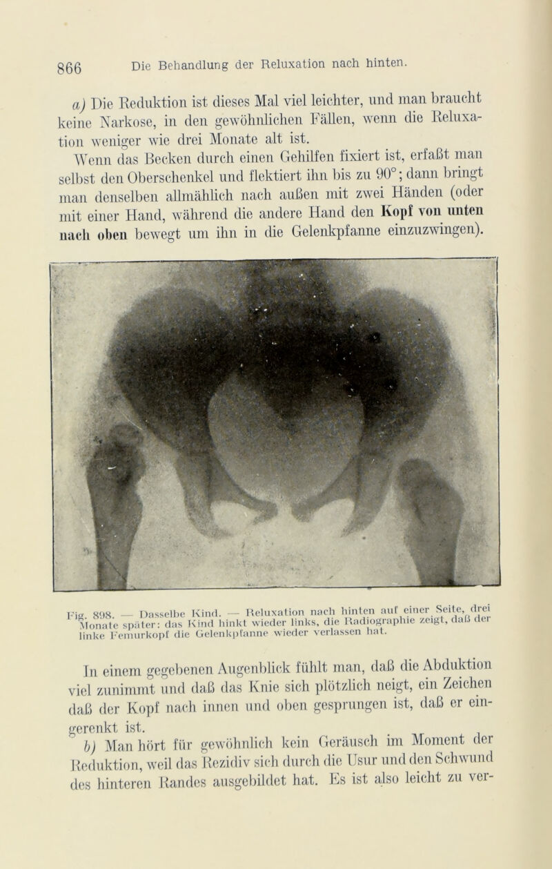 a) Die Reduktion ist dieses Mal viel lelchter, und man braucht keine Narkose, in den gewôhiüichen Fâllen, wenn die Reluxa- tion weniger wie drei Monate ait ist. Wenn das Becken durch einen Geliilfen fixiert ist, erfaBt man selbst den Oberschenkel und flektiert ihn bis zu 90 ; daim biingt man denselben allmahlieh nach auBen mit zwei Hânden (oder mit einer Hand, wâhrend die andere Hand den Kopf von unten nach oben bewegt uni ihn in die Gelenkpfanne einzuzwingen). Fig. 898. — Dasselbe Kind. — Reluxation nach hinten auf einer Seite, drei Monate spiiter: das Kind hinkt wieder links, die Radiographie zeigt, dafi ünke Femurkopf die Gelenkpfanne wieder verlassen liât. In einem gegebencn Augenblick fiihlt man, daB die Abduktion viel zunimmt und daB das Knie sich plôtzlich neigt, ein Zeichen daB der Kopf nach innen und oben gesprungen ist, daB er ein- gerenkt ist. b) Manhdrt für gewohnlich kein Gerausch im Moment der Reduktion, weil das Rezidiv sich durch die Usur und den Schwund des hinteren Randes ausgebildet hat. Es ist also leicht zu ver-