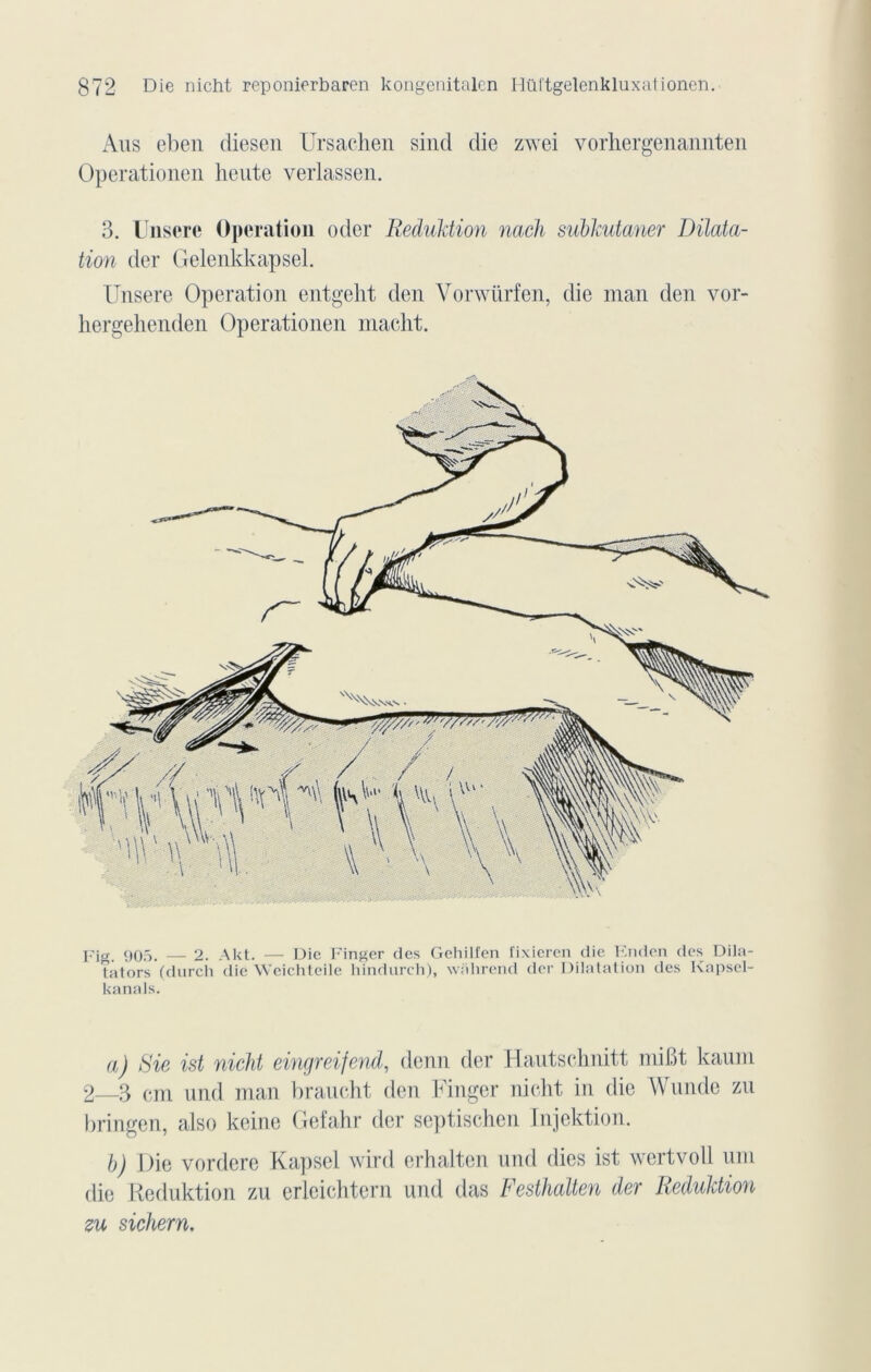 Ans eben diesen Ursachen sind die zwei vorhergenannten Operationen lieute verlassen. 3. Unsere Operation oder Reduktion nach subkutaner Dilata- tion der Gelenkkapsel. Unsere Operation entgeht den Vorwürfen, die man den vor- hergehenden Operationen macht. Fig. 905. — 2. Akt. — Die Finger des Gehilfen fixieren die Knden des Dila- Tators (durcli die Wcichteile hindureh), walirend der Dilatation des Kapsel- kanals. a) Rie ist nicht eingreifend, denn der Hautschnitt miBt kaum 2_3 cm und man brandit den Finger nicht in die Wunde zn bringen, also keine Gefahr der septischen Injektion. b) Die vordere Kapsel wird erhalten und (lies ist wertvoll uni die Reduktion zu erlcichtern und das Festhalten der Reduktion zu sichern.