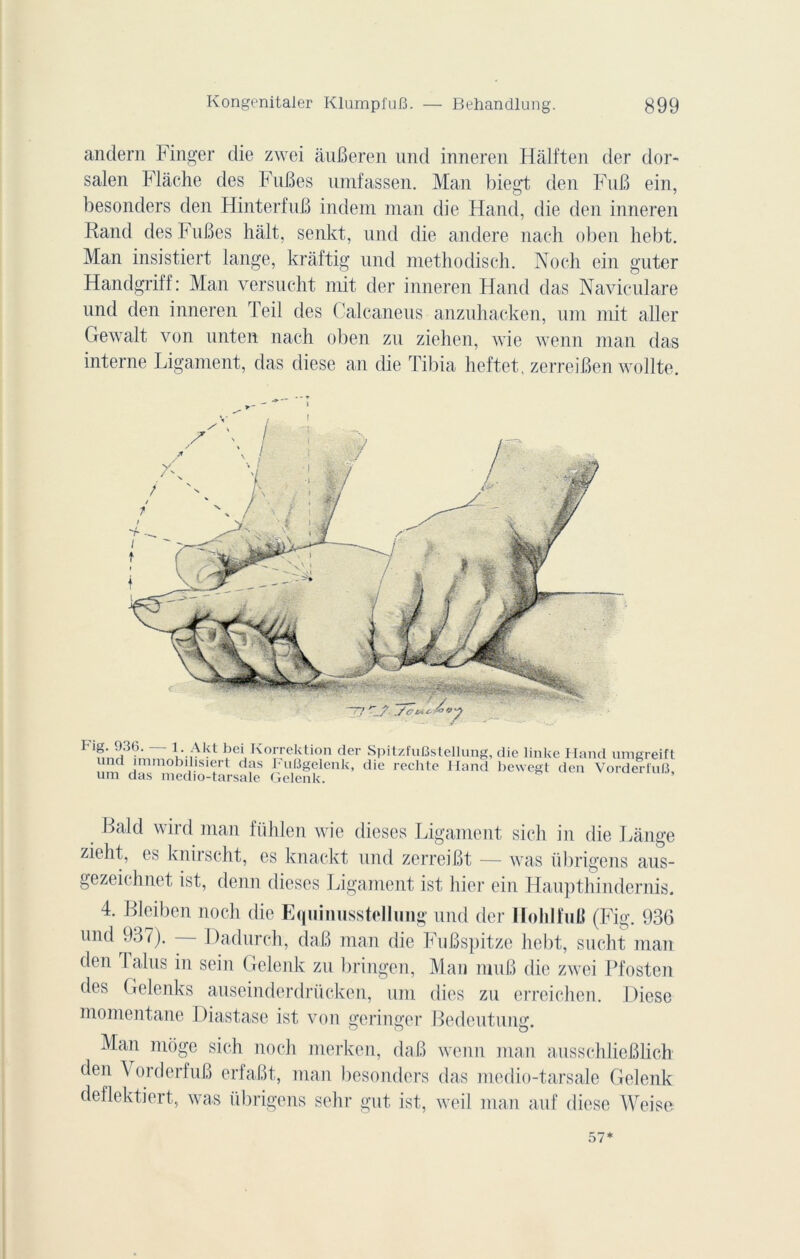 andern Finger die zwei âuBeren und inneren Hâlften der dor- salen Flàche des FuBes umfassen. Man biegt den FuB ein, besonders den HinterfuB indem man die Hand, die den inneren Rand des FuBes hait, senkt, und die andere nach oben hebt. Man insistiert lange, kràftig und methodisch. Noch ein guter Handgriff: Man versucht mit der inneren Hand das Naviculare und den inneren 1 eil des Calcaneus anzuhacken, uni mit aller Gewalt von unten nach oben zu ziehen, wie wenn man das interne Ligament, das diese an die Tibia heftet, zerreiBen wollte. r-ig. 936. l-Akl bei Korrektion der SpitzfuBstellung, die linke Hand umgreift und immobilisiert das FuBgelenk, die rechte Hand bewegt den VorderiuB um das medio-tarsale Gelenk. Bald wird man fiihlen wie dieses Ligament sich in die Lange zieht, es knirscht, es knackt und zerreiBt — was übrigens aus- gezeiehnet ist, clenn dieses Ligament ist hier ein Haupthindernis. 4. Bleiben noch die Equiimsstellung und der Iloklfufi (Fig. 936 und 937). Dadurch, daB man die FuBspitze hebt, sucht man den I alus in sein Gelenk zu bringen, Man muB die zwei Pfosten des Gelenks auseinderdrücken, uni dies zu erreichen. Diese momentané Diastase ist von geringer Bedeutung Man môge sich noch merken, daB wenn man ausschlieBlich den \ orderfuB erfaBt, man besonders das medio-tarsale Gelenk deflektiert, was übrigens sehr gut ist, weil man auf diese Weise 57*