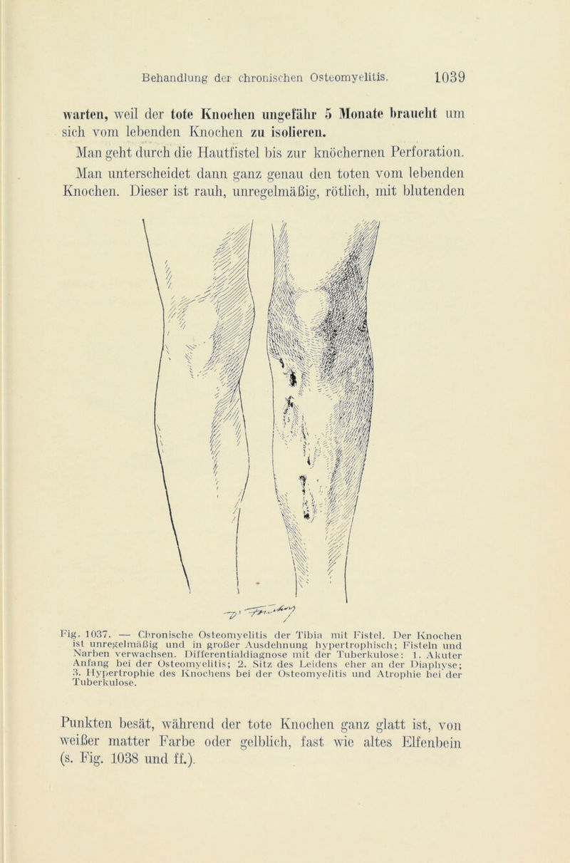 warten, weil der tote Knoclien ungefâhr 5 Monate braueht um sich vom lebenden Knochen zu isolieren. Man geht durch die Hautfistel bis zur knochernen Perforation. Man unterscheidet dann ganz genau den toten vom lebenden Knochen. Dieser ist ranh, nnregelmàBig, rotlich, mit blutenden Fig. 1037. — Chronische Osteomyelilis der Tibia mit Fistel. Der Knochen ist unregelmâBig und in grofier Ausdehnung hypertrophisch; Fisteln und Narben vervvachsen. Differentialdiagnose mit der Tuberkulose: I. Alcuter Anfang bei der Osteomyelitis; 2. Sitz des Leidens cher an der Diaphyse; 3. Hypertrophie des Knochens bei der Osteomye/itis und Atrophie bei der Tuberkulose. Pnnkten besàt, wàhrend der tote Knochen ganz glatt ist, von weifier matter Farbe oder gelblich, fast wie altes Elfenbein (s. Fig. 1038 und ff.).