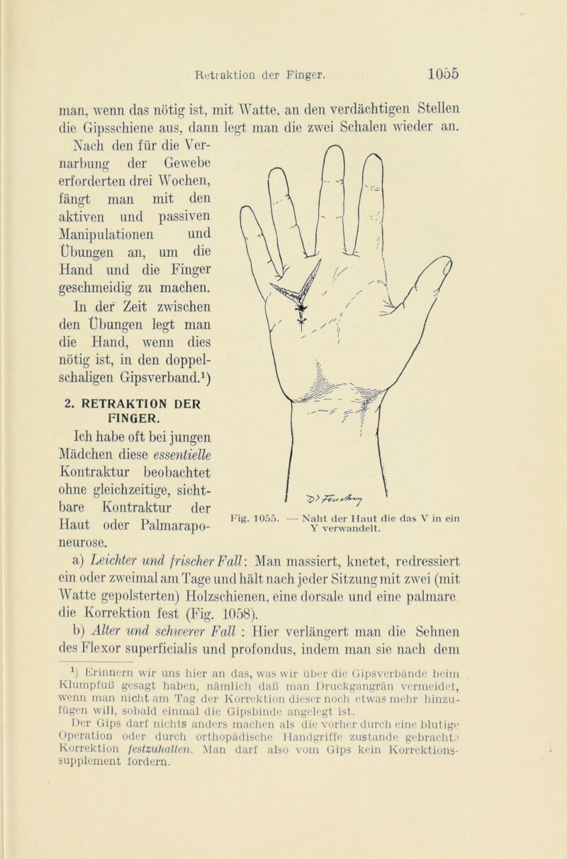 man, wenn das notig ist, mit Watte. an den verdâchtigen Stellen die Gipsschiene aus, dann legt man die zwei Schalen wieder an. Nach den fiir die Ver- narbung der Gewebe erforderten drei Wochen, fàngt man mit den aktiven nnd passiven Manipulationen und Übungen an, uni die Hand und die Finger geschmeidig zu machen. In der Zeit zwischen den Übungen legt man die Hand, wenn dies notig ist, in den doppel- schaligen Gipsverband.1) 2. RETRAKTION DER FINGER. Ich habe oft bei jungen Màdchen diese essentielle Kontraktur beobachtet ohne gleichzeitige, sicht- bare Kontraktur der Haut oder Palmarapo- neurose. a) Leichter und jrischer Fcdl : Man massiert, knetet, redrcssiert ein oder zweimal am Tage und hait nach je der Sitzungmit zwei (mit Watte gepolsterten) Holzschienen, einc dorsale und eine palmare die Korrektion fest (Fig. 1058). b) Alter und schiuerer Fall : Hier verlangert man die Sehnen des Flexor superficialis und profondus, indem man sie nach dcm 0 Erinnern wir uns hier an das, was wir über die Gipsverbànde beim KlumpfuB gcsagt liaben, nâmlich daB man Druckgangrân vcrmcidet, wenn man nicht am Tag der Korrektion dieser noch etwas mchr hinzu- fügen will, sobald einmal die Gipsbinde angelegt ist. Der Gips darf nichts anders machen als die vorher durch eine blutige Operation oder durch orthopadischc Handgriffe zustande gebrachtc Korrektion festzuhalten. Man darf also vom Gips kein Korrcktions- supplement fordern. Fig. 1055. — Naht der Haut die das V in ein Y verwandelt.