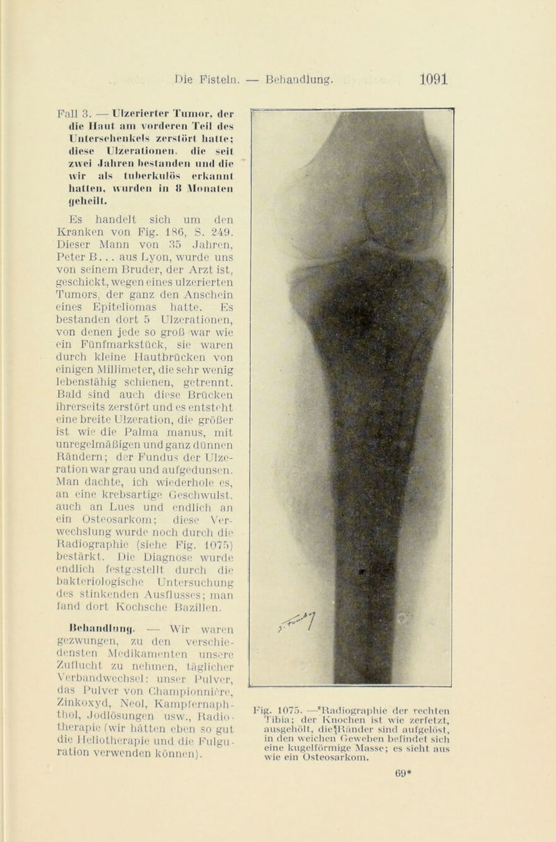 Fall 3. — Ulzeriertcr Tumor. der die Haut am vorderen Tei! des Untersehenkels zerslort halle; diese Ulzeralionen. die seil znei Jaliren bestanden und die vvir als tuberkulos erkanut haüen. wurden in H jVIonaten «jeheilt. Es handelt sich um don Kranken von Fig. 136, S. 249. Diescr Mann von 35 Jahren, Peter B... aus Lyon, wurde uns von scinem Bruder, der Arzt ist, geschickt, wegen eines ulzerierten Tumors. der ganz den Ansohein eines Epitcliomas batte. Es bestanden dort 5 Ulzerationen, von denen jede so groB war wie ein Fünfmarkstilck, sie waren durch kleine Hautbrücken von einigen Millimeter, die sehr wenig lebenstahig schienen, getrennt. Bald sind auch diese Brücken ihrcrseits zerstôrt und es entsteht einebreitc Ulzeration, die groBer ist wie die Palma manus, mit unregelmâBigen und ganz dünncn Rândern; der Fundus der UJzc- ration war grau und aul'gedunsen. Man daclitc, ich wiederhole es, an oine krebsartige Geschwulst, auch an Lues und endlich an ein Osteosarkom; diese Ver- wcchslung wurde noch durch die Radiographie (siehe Fig. 1075) bestârkt. Die Diagnose wurde cndlich festgestellt durch die bakteriologische Untersuchung des stinkenden Ausflusses; man land dort Kochsche Bazillen. Uchnndlumj. — Wir waren gezwungen, zu den verschie- densten Mcdikamentcn unsere Zullucht. zu nehmcn, tâglicher Verbandwechsel : unser Pulvcr, das Pulver von Ghampionnièro, Zinkoxyd, Neol, Kamplernaph- thol, Jodlôsungcn usw., Radio- thérapie (wir hatten ehen so gut die Héliothérapie und die Fulgu- ration verwenden kônnen). Fig. 1075. —'Radiographie der rechten Tibia; der Knochen ist wie zerfetzt, ausgeliolt, dieRUinder sind aufgelôst, in den weichen Geweben befindet sich eine kugelfôrmige Masse; es sieht ans wie ein Osteosarkom.