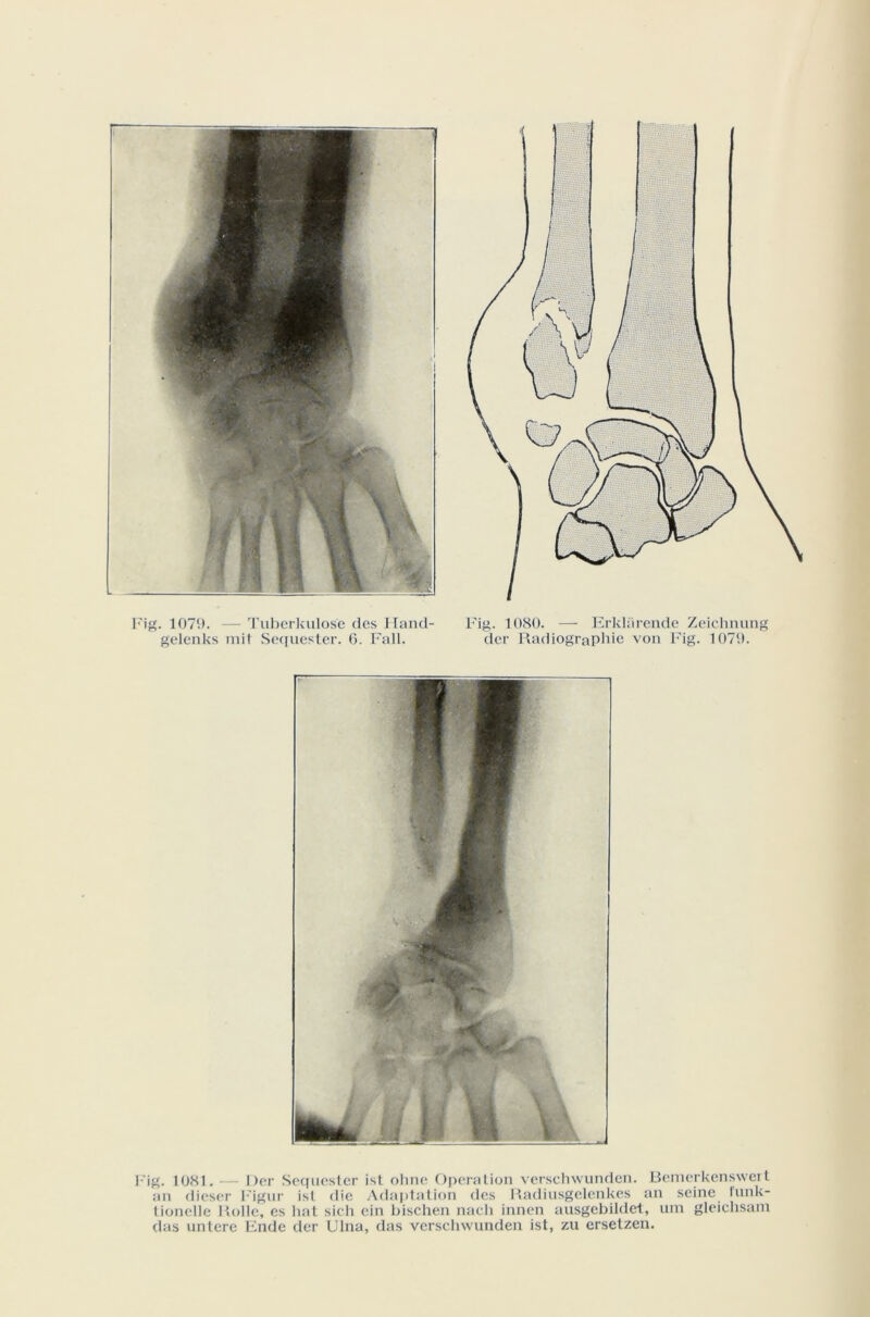 Fig. 1079. — Tuberkulose des Hand- gelenks mit Sequester. 6. Fait. Fig. 1080. — Erkla rende Zeichnung der Radiographie von Fig. 1079. Fig. 1081. — Der Sequester ist oh ne Operation verschwunden. Bemerkenswert an dieser Figur ist die Adaptation des Radiusgelenkes an seine funk- tionclle Rolle, es liât sich ein bischen nacli innen ausgebildet, um gleichsam das untere Ende der Ulna, das verschwunden ist, zu ersetzen.