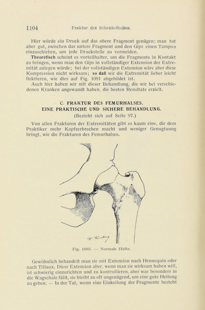 Hier wiirde ein Druck auf das obéré Fragment genügen; man tut aber gut, zwischen das untere Fragment und den Gips einen Tampon einzuschiebenr uni jede Druckstelle zu vermeiden. Theoretisch scheint es vorteilhalter, uni die Fragmente in Kontakt zu bringen, wenn man den Gips in vollstàndiger Extension der Extre- mitat anlegen wiirde; bei der vollstàndigen Extension ware aber diese Kompression nicht wirksam; so dall wir die Extremitàt lieber leiclit flektieren, wie dies auf Fig. 1091 abgebildet ist. Auch hier haben wir mit dieser Behandlung, die wir bei verschie- denen Kranken angewandt haben, die besten Resultate erzielt. C. FRAKTUR DES FEMURHALSES. EINE PRAKTISCHE UND SICHERE BEHANDLUNG. (Bezieht sich auf Seite 97.) Von allen Frakturen der Extremitâten gibt es kaum eine, die dem Praktiker mehr Kopfzerbrechen macht und weniger Genugtuung bringt, wie die Frakturen des Femurhalses. Fig. 1093. — Normale Hiifte. Gewohnlich behandelt man sic mit Extension nach Hennequin oder nach Tillaux. Diese Extension aber, wenn man sie wirksam haben will, ist schwierig einzurichten und zu kontrollieren, aber was besonders in die Wagschale fàllt, sie bleibt zu oft ungenügend, um eine gute Heilung zugeben. — InderTat, wenn eine Einkeilung der Fragmente besteht