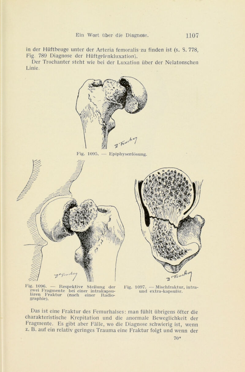 in der Hiiftbeuge unter der Arteria femoralis zu finden ist (s. S. 778, Fig. 789 Diagnose der Hüftgelenkluxation). Der Trochanter steht wie bei der Luxation über der Nelatonschen Linie. Fig. 1095. — Epiphysenlôsung. l'ig. 1096. — Respektive Stellung der Fig. 1097. —Mischfraktur, intra- zwei Fragmente bei einer intrakapsu- und extra-kapsulâr. laren Fraktur (nach einer Radio- graphie). Das ist eine Fraktur des Femurhalses: man fülilt übrigens ofter die charakteristische Krepitation und die anormale Beweglichkeit der Fragmente. Es gibt aber Falle, wo die Diagnose schwierig ist, wenn z. B. auf ein relativ geringes Trauma eine Fraktur folgt und wenn der 70*