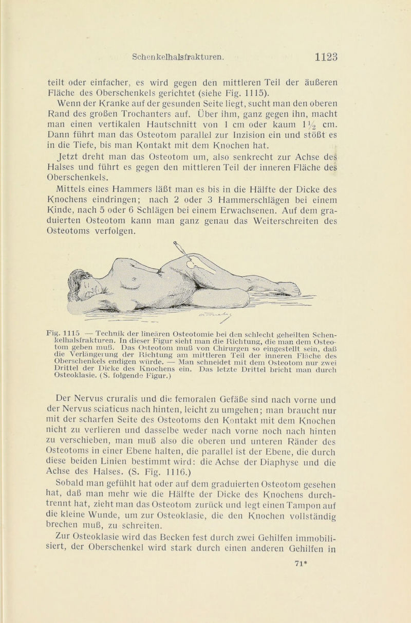 teilt oder einfacher, es wird gegen den mittleren Teil der âuBeren Flâche des Oberschenkels gerichtet (siehe Fig. 1115). Wenn der Kranke auf der gesunden Seite liegt, sncht man den oberen Rand des groBen Trochanters auf. Über ihm, ganz gegen ihn, macht man einen vertikalen Hautschnitt von 1 cm oder kaum 1 % cm. Dann fiihrt man das Osteotom parallel zur Inzision ein und stdBt es in die Tiefe, bis man Kontakt mit dem Knochen bat. Jetzt dreht man das Osteotom um, also senkrecht zur Achse des Halses und führt es gegen den mittleren Teil der inneren Flâche des Oberschenkels. Mittels eines Hammers lâBt man es bis in die Hâlfte der Dicke des Knochens eindringen; nach 2 oder 3 Hammerschlâgen bei einem Kinde, nach 5 oder 6 Schlâgen bei einem Erwachsenen. Auf dem gra- duierten Osteotom kann man ganz genau das Weiterschreiten des Osteotoms verfolgen. Fig. 1115 — Technik der lineàren Ostéotomie bei den schlecht geheilten Schen- kelhalsi'rakturen. In tlieser Figur sieht man die Richtung, die man dem üsteo- loin geben muQ. Das Osteotom muB von Chirurgen so eingestellt sein, dab die Verlàngei ung der Richtung am mittleren Teil der inneren Floche des Oberschenkels endigen würde. — Man schneidet mit dem Osteotom nur zwei Drittel der Dieke des Knochens ein. Das letzte Drittel bricht man durcli Osteoklasie. (S. lolgende Figur.) Der Nervus cruralis und die femoralen GefâBe sind nach vorne und der Nervus sciaticus nach hinten, leicht zu umgehen; man braucht nur mit der scharfen Seite des Osteotoms den Kontakt mit dem Knochen nicht zu verliercn und dasselbe weder nach vorne nocli nach hinten zu verschieben, man muB also die oberen und unteren Rânder des Osteotoms in einer Ebene halten, die parallel ist der Ebene, die durcit diese beiden Linien bestimmt wird : die Achse der Diaphyse und die Achse des Halses. (S. Fig. 1116.) Sobald man gefiihlt hat oder auf dem graduierten Osteotom gesehen hat, daB man mehr wie die Hâlfte der Dicke des Knochens durch- trennt hat, zieht man das Osteotom zuriick und legt einen Tampon auf die kleine Wunde, um zur Osteoklasie, die den Knochen vollstândig brechen muB, zu schreiten. Zur Osteoklasie wird das Becken fest durch zwei Gehilfen immobili- siert, der Oberschenkel wird stark durch einen anderen Gehilfen in 71*