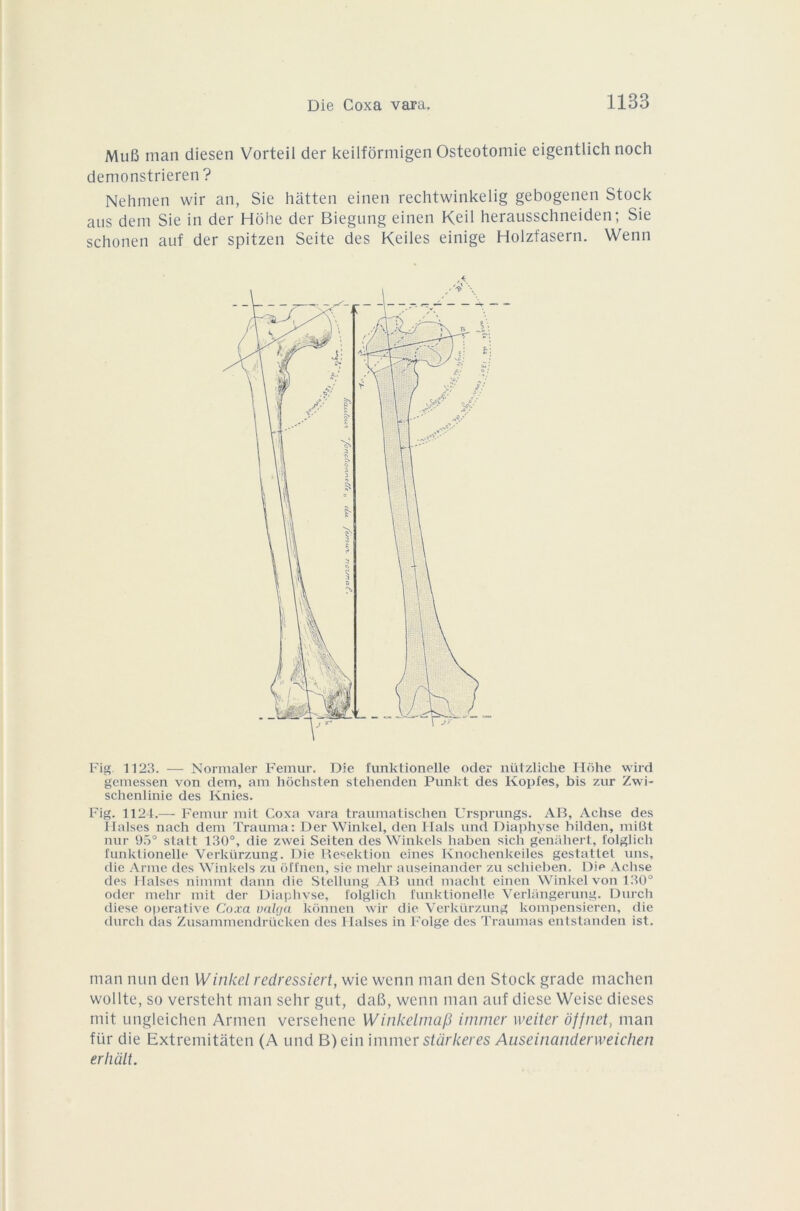 MuB man diesen Vorteil der keilfôrmigen Ostéotomie eigentlich noch demonstrieren? Nehmen wir an, Sie hatten einen rechtwinkelig gebogenen Stock ans dem Sie in der Hôhe der Biegung einen Keil herausschneiden; Sie schonen auf der spitzen Seite des Keiles einige Holzfasern. Wenn Fig 1123. — Normaler Fémur, Die funktionelle oder nützliche Hohe wird gemessen von dem, am hôchsten stehenden Punkt des Kopfes, bis zur Zwi- schenlinie des Knies. Fig. 1124.—- Fémur mit Coxa vara traumatischen Ursprungs. AB, Achse des Haises nach dem Trauma: Der Winkel, den Hais und Diaphyse bilden, miBt nur 95° statt 130°, die zwei Seiten des Winkels haben sich genàhert, I'olglich lunktionelle Verkürzung. Die Resektion eines Knochenkeiles gestattet uns, die Arme des Winkels zu ofi'nen, sie mehr auseinander zu schieben. Dip Achse des I lalses nimmt dann die Stellung AB und macht einen Winkel von 130° oder mehr mit der Diaphyse, i'olglich funktionelle Verlangerung. Durch diese operative Coxa valga konnen wir die Verkürzung kompensieren, die durch das Zusammendrücken des Haises in Folge des Traumas entstanden ist. man nun den Winkel redressiert, wie wenn man den Stock grade machen wollte, so versteht man selir gut, daB, wenn man anf diese Weise dieses mit ungleichen Armen versehene Winkelmap immer weiter djfnet, man für die Extremitàten (A und B)ein immer starkeres Auseinandenveichen erhalt.