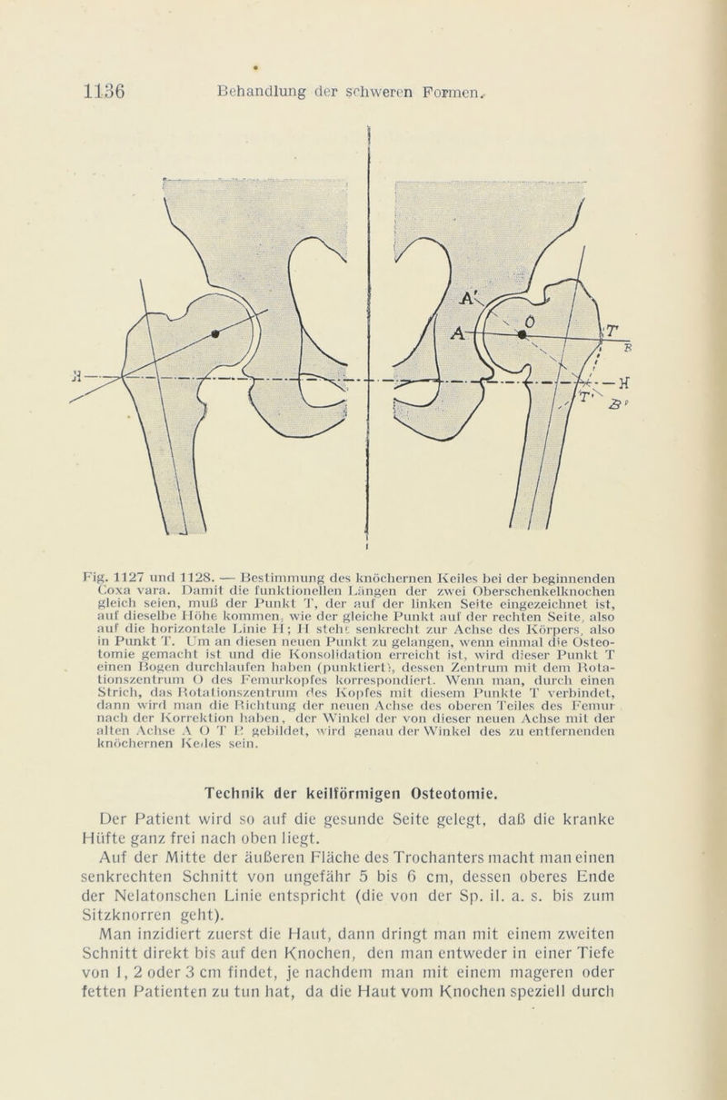 Fig. 1127 und 1128. — Bestimmung des knôchernen Keiles bei der beginnenden Coxa vara. Damit die funktionellen Lângen der zwei Oberschenkelknochen gleich seien, muC der Punkt T, der auf der linken Seite eingezeichnet ist, auf dieselbe Hôhe kommen, wie der gleiche Punkt auf der rechten Seite, also auf die horizontale Finie H; II steht senkrecht zur Achse des Kôrpers, also in Punkt T. Um an diesen neuen Punkt zu gelangen, wenn einmal die Ostéo- tomie gemacht ist und die Konsolidation erreicht ist, wird dieser Punkt T einen Bogen durchlaufen haben (punkt iert:, dessen Zentrum mit dem Rota- tionszentrum O des Femurkopfes korrespondiert. Wenn man, durch einen Strich, das Botationszentrum des Kopfes mit diesem Punkte T verbindet, dann wird man die Richtung der neuen Achse des oberen Teiles des Fémur naeh der Korrektion haben, der Winkel der von dieser neuen Achse mit der alten Achse A O T P gebildet, wird genau der Winkel des zu entfernenden knôchernen Kedes sein. Technik der keilformigen Ostéotomie. Der Patient wird so auf die gesunde Seite gelegt, dafi die kranke Hiifte ganz frei nacli obeti liegt. Auf der Mitte der àuBeren Flâche des Trochanters macht man einen senkrechten Schnitt von ungefâhr 5 bis 6 cm, dessen obérés Ende der Nelatonschen Linie entspricht (die von der Sp. il. a. s. bis zum Sitzknorren geht). Man inzidiert zuerst die Haut, dann dringt man mit einem zweiten Schnitt direkt bis auf den Knochen, den man entweder in einer Tiefe von 1,2 oder 3 cm findet, je nachdem man mit einem mageren oder fetten Patienten zu tun hat, da die Haut vom Knochen speziell durch