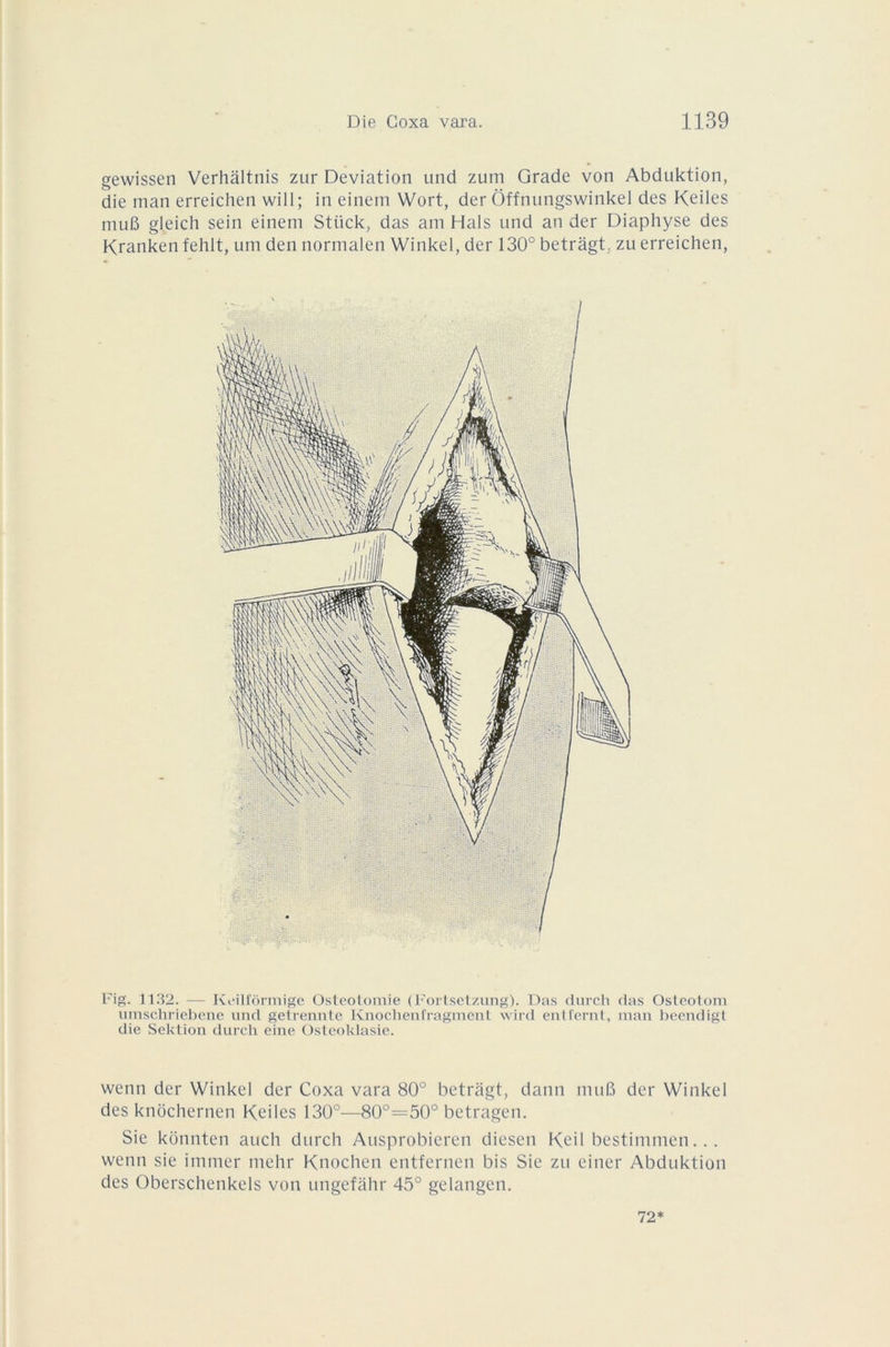 gewissen Verhâltnis zur Déviation und zum Grade von Abduktion, die man erreichen will; in einem Wort, der Ôffnnngswinkel des Keiles muB gleich sein einem Stück, das am Hais und an der Diaphyse des Kranken fehlt, um den normalen Winkel, der 130° betrâgt. zu erreichen, Fig. 1132. — Keilfôrmigè Ostéotomie (Fortsetzung). Das durch das Osteotom umschriebene und getrennte Knochenfragment wird entfernt, man beendigt die Scktion durch eine Osteoklasie. wenn der Winkel der Coxa vara 80° betrâgt, dann muB der Winkel des knochernen Keiles 130°—80°—50° betragen. Sie konnten auch durch Ausprobieren diesen Keil bestimmen... wenn sie immer mehr Knochen entfernen bis Sie zu einer Abduktion des Oberschenkels von ungefàhr 45° gelangen. 72*