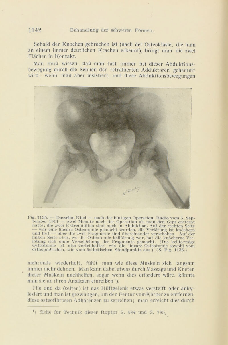 Sobald der Knochen gebrochen ist (nach der Osteoklasie, die man an einem immer deutlichen Krachen erkennt), bringt man die zwei Flâchen in Kontakt. Man muB wissen, daB man fast immer bei dieser Abduktions- bewegung durch die Sehnen der retrahierten Adduktoren gehemmt wird ; wenn man aber insistiert, und diese Abduktionsbewegungen Fig. 1135. — Dasselbe Kind — nach der blutigen Operation, Radio vom 5. Sep- tember 1911 — zwei Monate nach der Operation als man den Gips entfernt hatte; die zwei Extremitaten sind noch in Abduktion. Auf der rechten Seite — war eine lineare Ostéotomie gemacht worden, die Verlôtung ist knôchern und fest — aber die zwei Fragmente sind übereinander verschoben. Auf der linken Seite aber, wo die Ostéotomie keilfôrmig war, liât die knochernc Ver- lotung sicli ohne Yerschiebung der Fragmente gemacht. (Die keilfôrmige Ostéotomie ist also vorteilhafter, wie die lineare Ostéotomie sowolil vom orthopüdischen, wie vom asthetischen Standpunkte aus ) (S. Fig. 1136.) mehrmals wiederholt, fühlt man wie diese Muskeln sich langsam immer mehr dehnen. Man kann dabei etwas durch Massage und Kneten dieser Muskeln nachhelfen, sogar wenn dies erfordert ware, konnte man sie an ihren Ansatzen einreiBen '). Hie und da (selten) ist das Hiiftgelenk etwas versteift oder anky- Iosiert und man ist gezwungen, uni den Fémur vom Korper zu entfernen, diese osteofibrcisen Adhârenzen zu zerreiBen; man erreicht dies durch 1) Siehe für Technik dieser Ruptur S. 484 und S. 785.