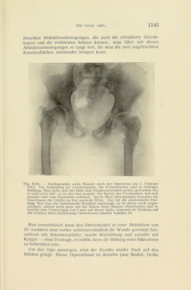 dieselben Abduktionsbewegungen, die auch die retrahierte Gelenk- kapsel und die verkiirzten Sehnen dehnen; man fâhrt mit diesen Abduktionsbewegungen so lange fort, bis man die zwei angefrischten Knochenflâchen aneinander bringen kann. Fig. 1136. — Radiographie seclis Monate nach der Operation am 5. Februar 1912 Die Abduktion ist verschwunden, die Extremitaten sind in richtiger Stellung. Man sieht, daP> der liais und Diaphysenwinkel grôfier geworden ist; er miRL jetzt 120% er ist also fast normal. Die Spitzc des Trochanters liât sich gesenkt und vom Darmbein entfernt; durch diese Rewegungen kommen die Insertionen der Glutæi in ihre normale Hohe. Das ■ ist die anatomische Hei- lung. Was nun das i'unktionelle Résultat anbelangt, so ist dieses aucli ausge- zeichnet. jedoch nicht ganz auf der linken Seite (lineare Ostéotomie) und es besteht eine Yerkürzung von 8 mm auf dieser Seite, wahrend die Ileilung auf der rechten Seite (keillôrmige Ostéotomie) absolut tadellos ist. Man immobilisiert dann den Oberschenkel in einer Abduktion von 45° nachdem man vorher selbstverstandlich die Wunde gereinigt liât; entfernt aile Knochensplitter, macht Blutstillung und vernâht mit Katgut — ohne Drainage, es müBte demi die Bildung eines Hàmatoms zu befürchten sein. Uni den Gips anzulegen, wird der Krankc wieder flacli auf den Rücken gelegt. Dieser Gipsverband ist derselbe (was Modell, GroBe