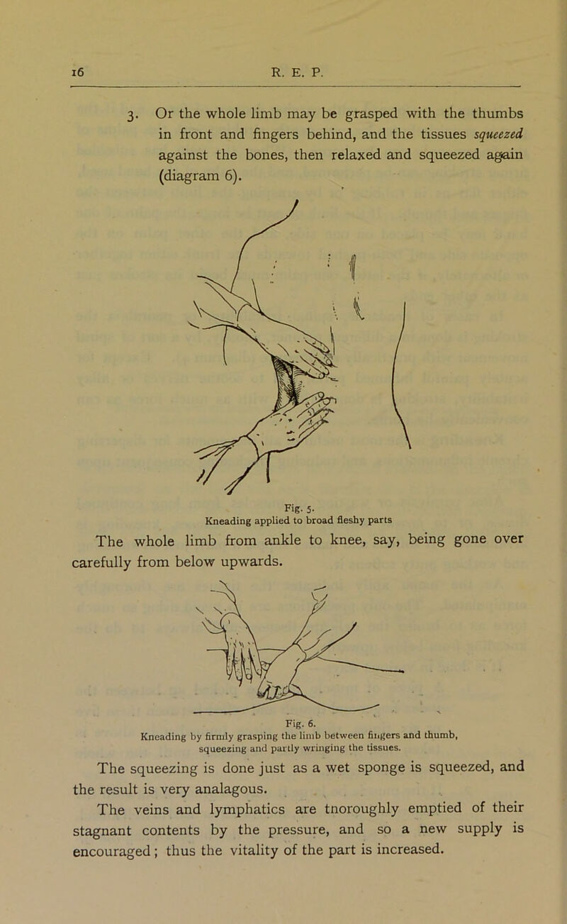 3. Or the whole limb may be grasped with the thumbs in front and fingers behind, and the tissues squeezed against the bones, then relaxed and squeezed again (diagram 6). Fig. 5- Kneading applied to broad fleshy parts The whole limb from ankle to knee, say, being gone over carefully from below upwards. Kneading by firmly grasping the limb between fingers and thumb, squeezing and partly wringing the tissues. The squeezing is done just as a wet sponge is squeezed, and the result is very analagous. The veins and lymphatics are tnoroughly emptied of their stagnant contents by the pressure, and so a new supply is encouraged; thus the vitality of the part is increased.