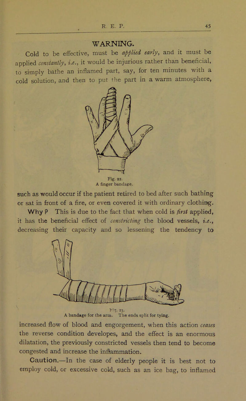 WARNING. Cold to be eflfective, must be applied early, and it must be applied constantly, i.e., it would be injurious rather than beneficial, to simply bathe an inflamed part, say, for ten minutes with a cold solution, and then to put the part in a warm atmosphere, Fig. 22. A finger bandage. such as would occur if the patient retired to bed after such bathing or sat in front of a fire, or even covered it with ordinary clothing. Why ? This is due to the fact that when cold is first applied, it has the beneficial effect of constricting the blood vessels, i.e., decreasing their capacity and so lessening the tendency to V’*?. 23, A bandage for the arm. The ends split for tying. increased flow of blood and engorgement, when this action ceases the reverse condition developes, and the effect is an enormous dilatation, the previously constricted vessels then tend to become congested and increase the inflammation. Caution.—In the case of elderly people it is best not to employ cold, or excessive cold, such as an ice bag, to inflamed