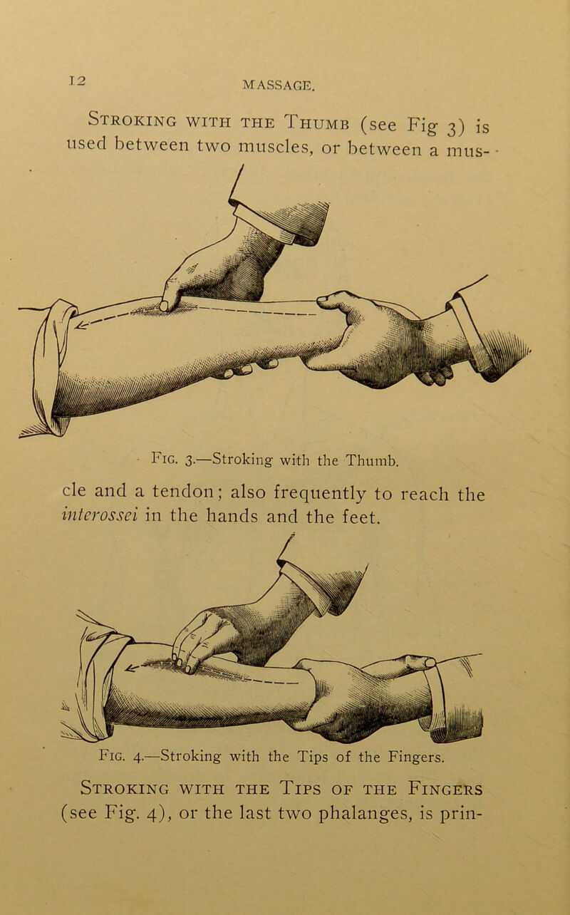 Stroking with the Thumb (see Fig- 3) is used between two muscles, or between a mus- ■ Fig. 3.—Stroking with the Thumb. cle and a tendon; also frequently to reach the interossei in the hands and the feet. Fig. 4.—Stroking with the Tips of the Fingers. Stroking with the Tips of the Fingers (see Fig. 4), or the last two phalanges, is prin-