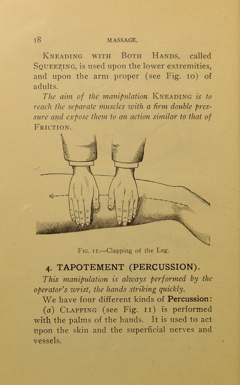 Kneading with Both Hands, called Squeezing, is used upon the lower extremities, and upon the arm proper (see Fig. io) of adults. The aim of the manipulation Kneading is to reach the separate muscles zvith a firm double pres- sure and expose them to an action similar to that of Friction. Fig. ii.—Clapping of the Leg. 4. TAPOTEMENT (PERCUSSION). This manipulation is ahvays performed by the operator's zvrist, the hands striking quickly. We have four different kinds of Percussion: (a) Clapping (see Fig. 11) is performed with the palms of the hands. It is used to act upon the skin and the superficial nerves and vessels.